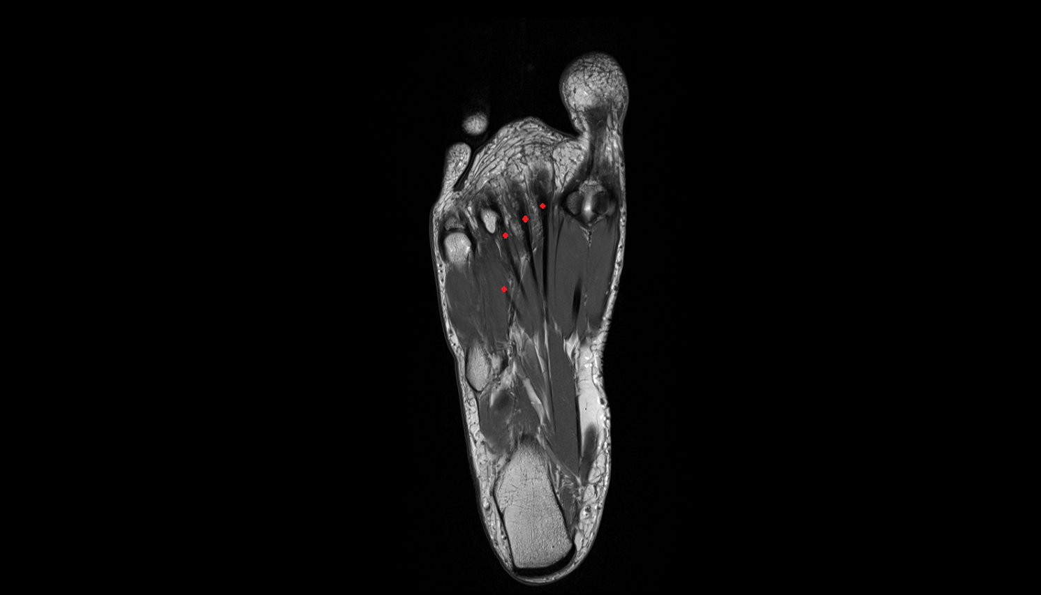 Flexor digitorum brevis tendons  of the Foot  coronal cross sectional anatomy 3T MRI AI enhanced radiology image-img-00000-00000