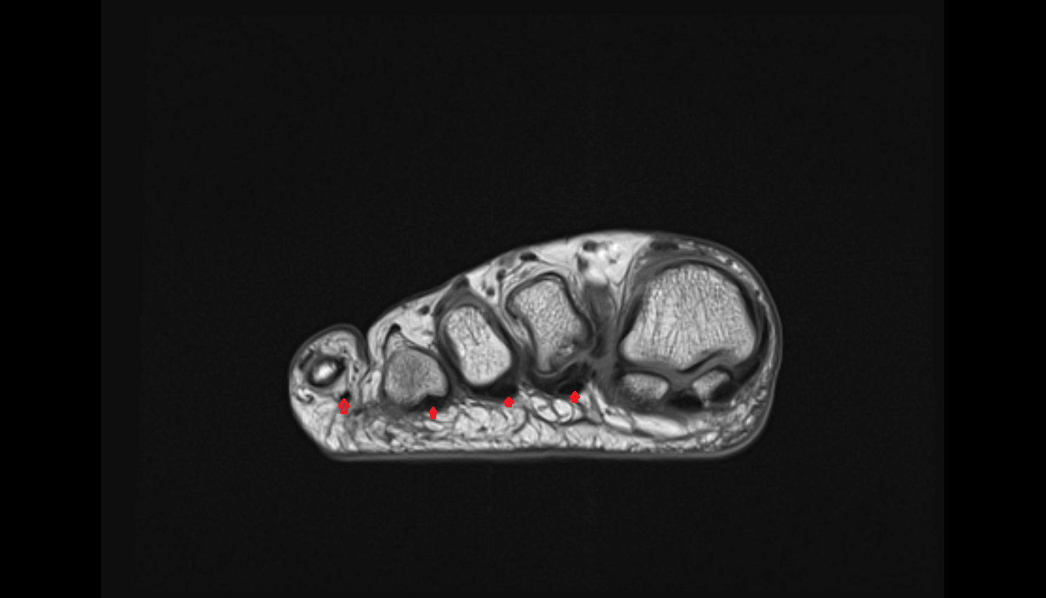 Flexor digitorum brevis tendons  of the Foot  coronal cross sectional anatomy 3T MRI AI enhanced radiology image-img-00000-00000_00001
