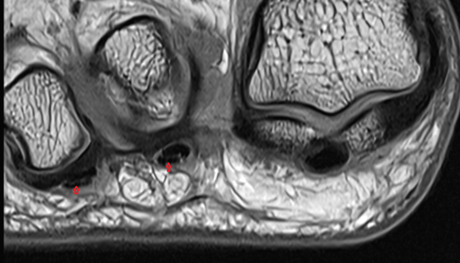 Flexor digitorum brevis tendons sfov  of the Foot  coronal cross sectional anatomy 3T MRI AI enhanced radiology image-img-00000-00000