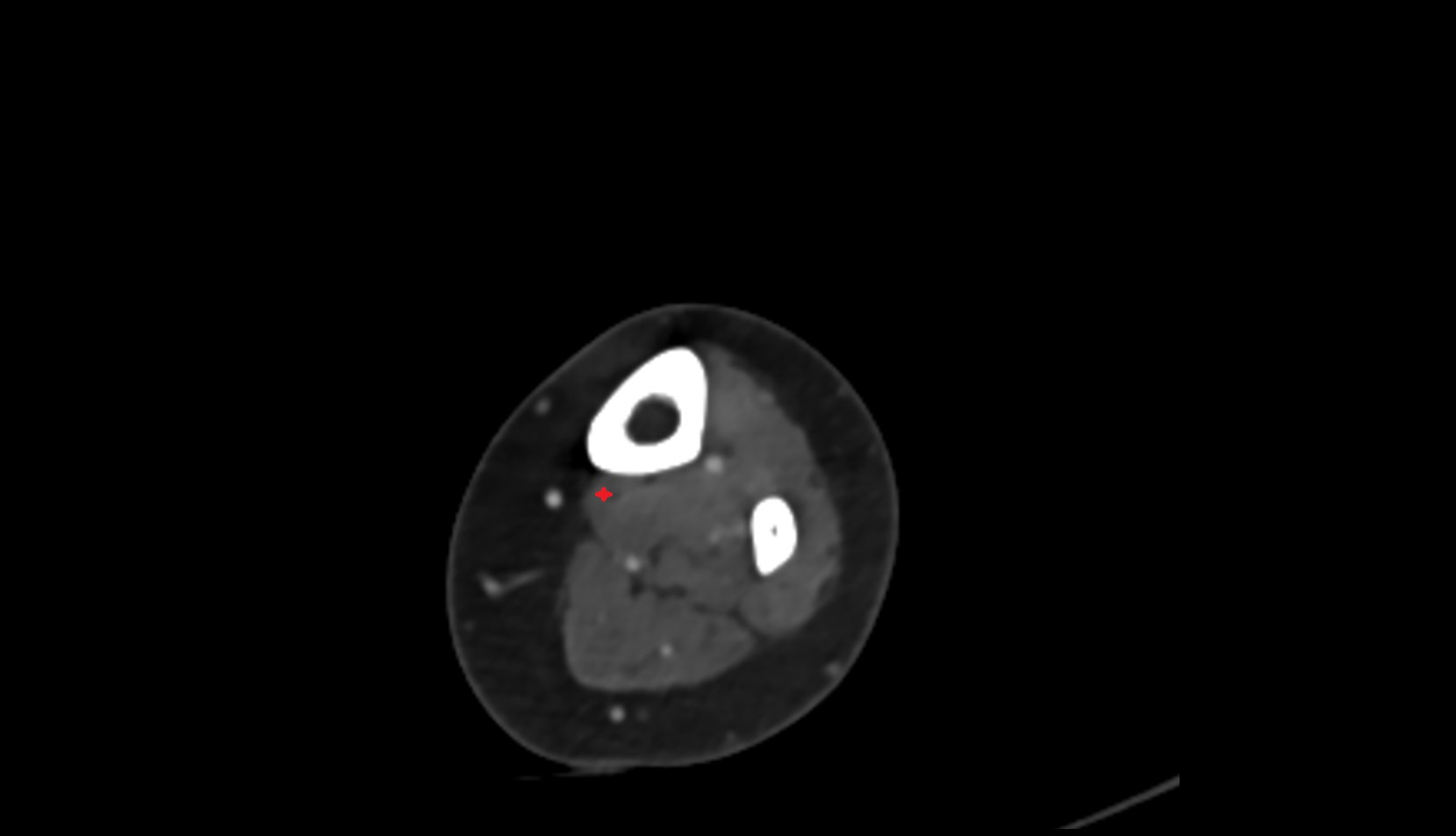 Flexor digitorum longus muscle 1