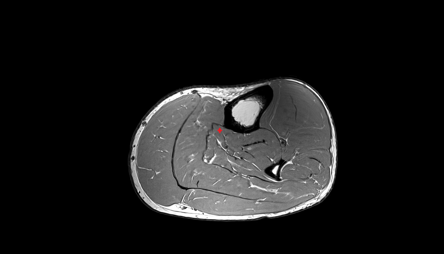 Flexor digitorum longus muscle axial cross sectional anatomy 3T MRI AI enhanced radiology image-img-00000-00000