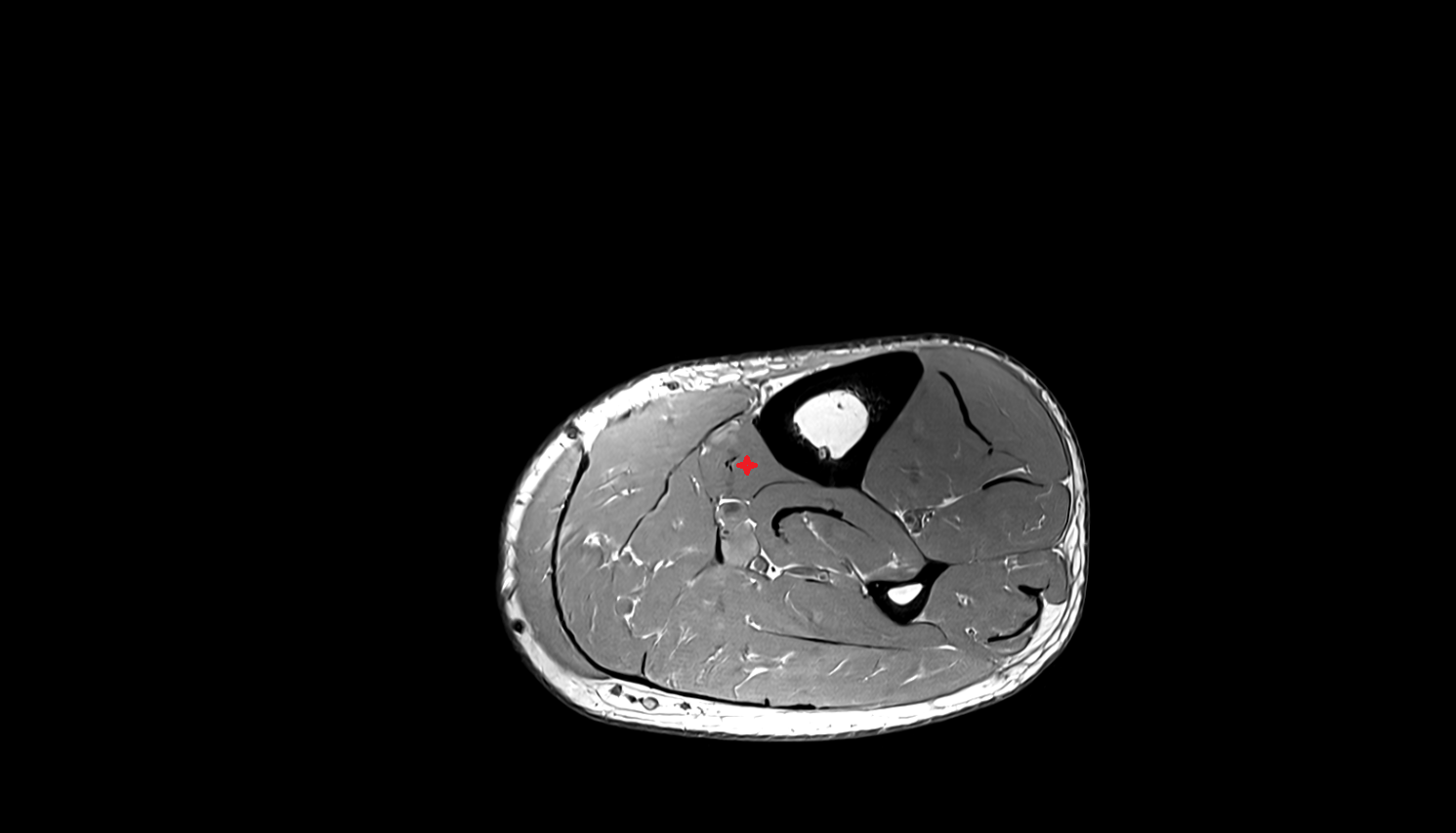Flexor digitorum longus muscle axial cross sectional anatomy 3T MRI AI enhanced radiology image-img-00000-00000_00001