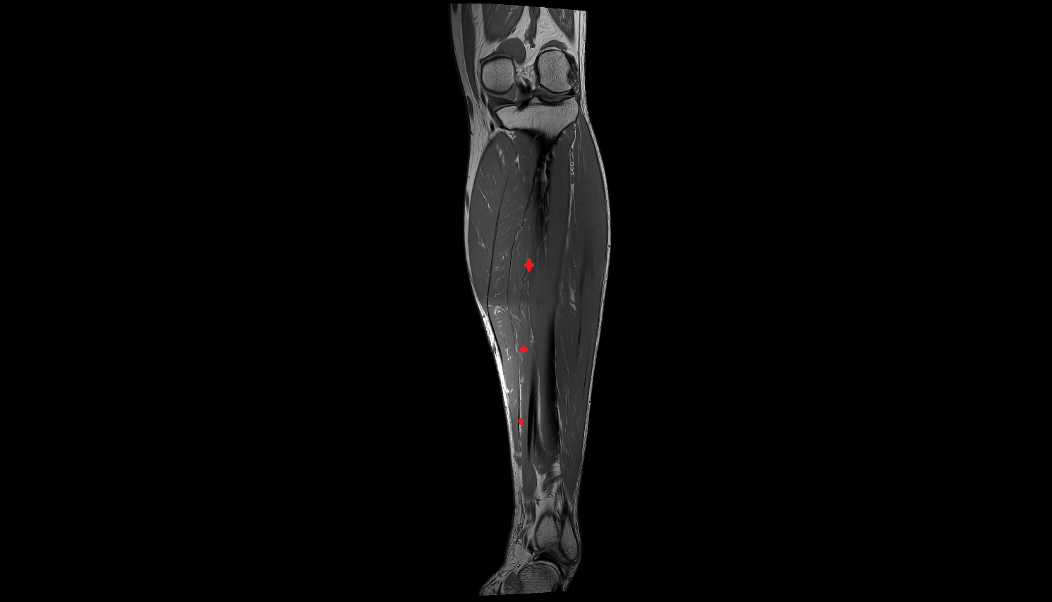 Flexor digitorum longus musclecoronal cross sectional anatomy 3T MRI AI enhanced radiology image-img-00000-00000