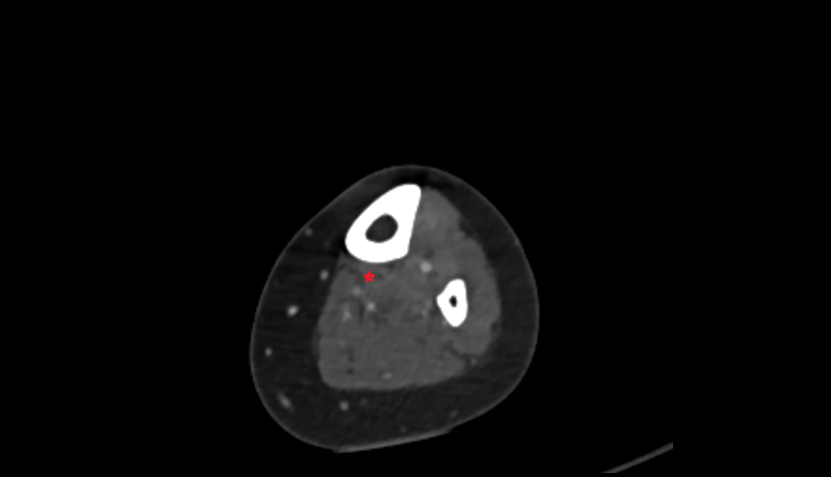 Flexor digitorum longus muscle ct axial