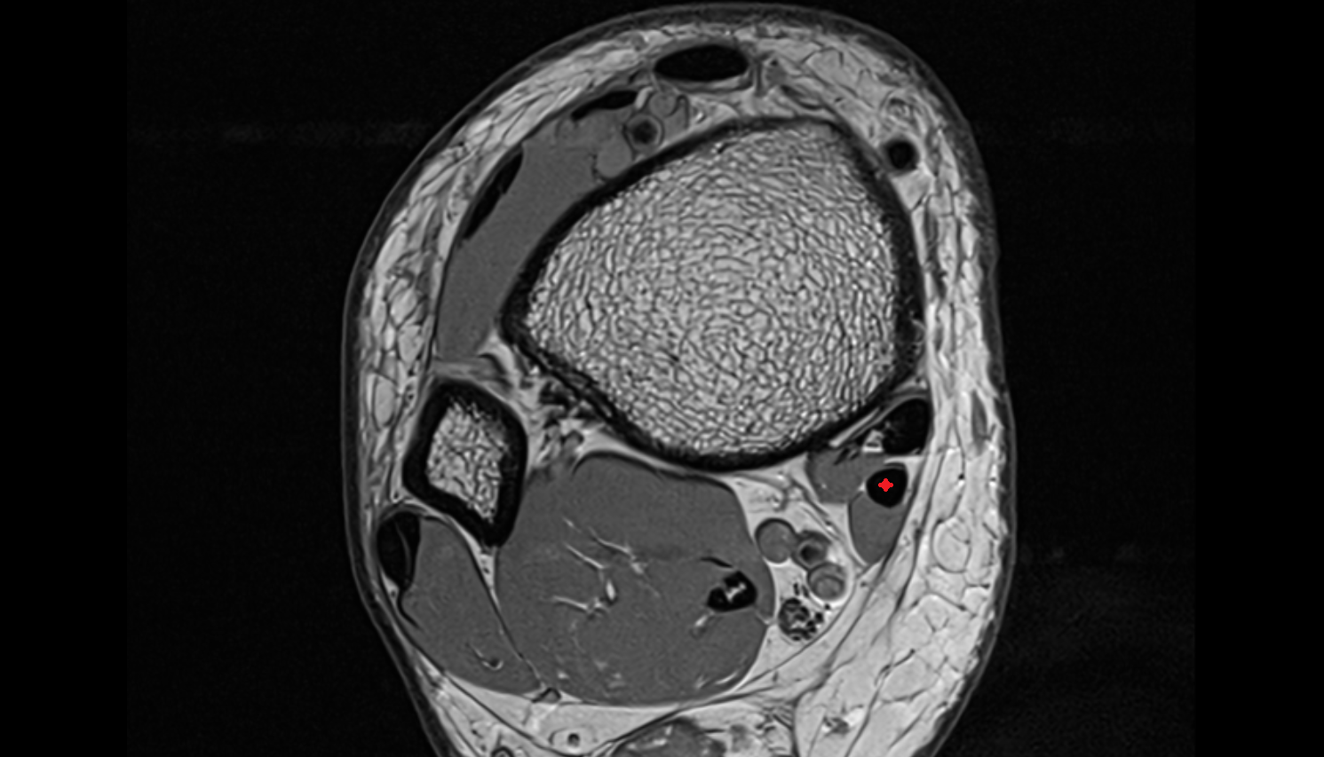 Flexor digitorum longus tendon  axial cross sectional anatomy 3T MRI AI enhanced radiology image-img-00000-00000_00002