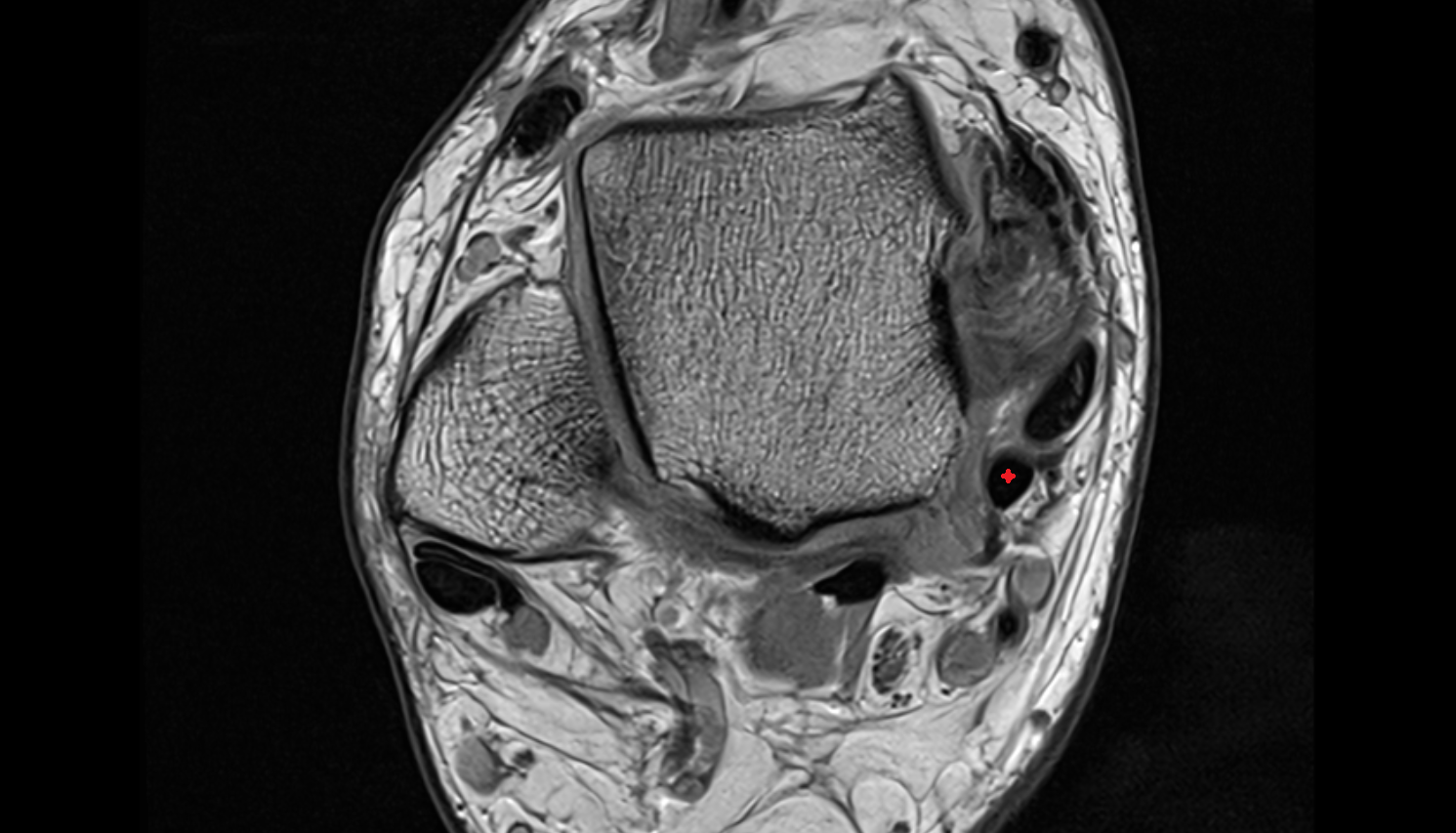 Flexor digitorum longus tendon  axial cross sectional anatomy 3T MRI AI enhanced radiology image-img-00000-00000_00003