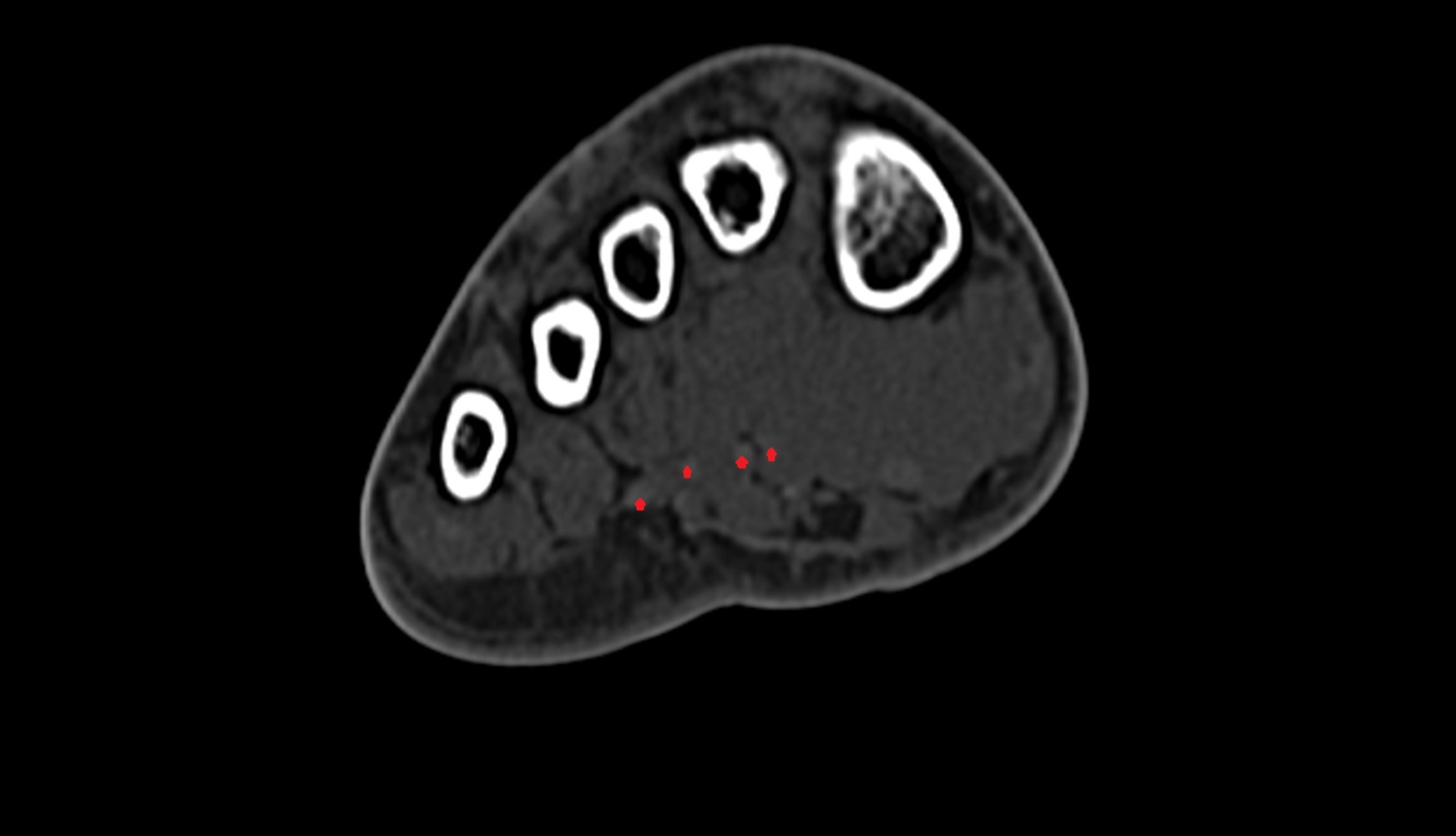 Flexor digitorum longus tendons ct axial