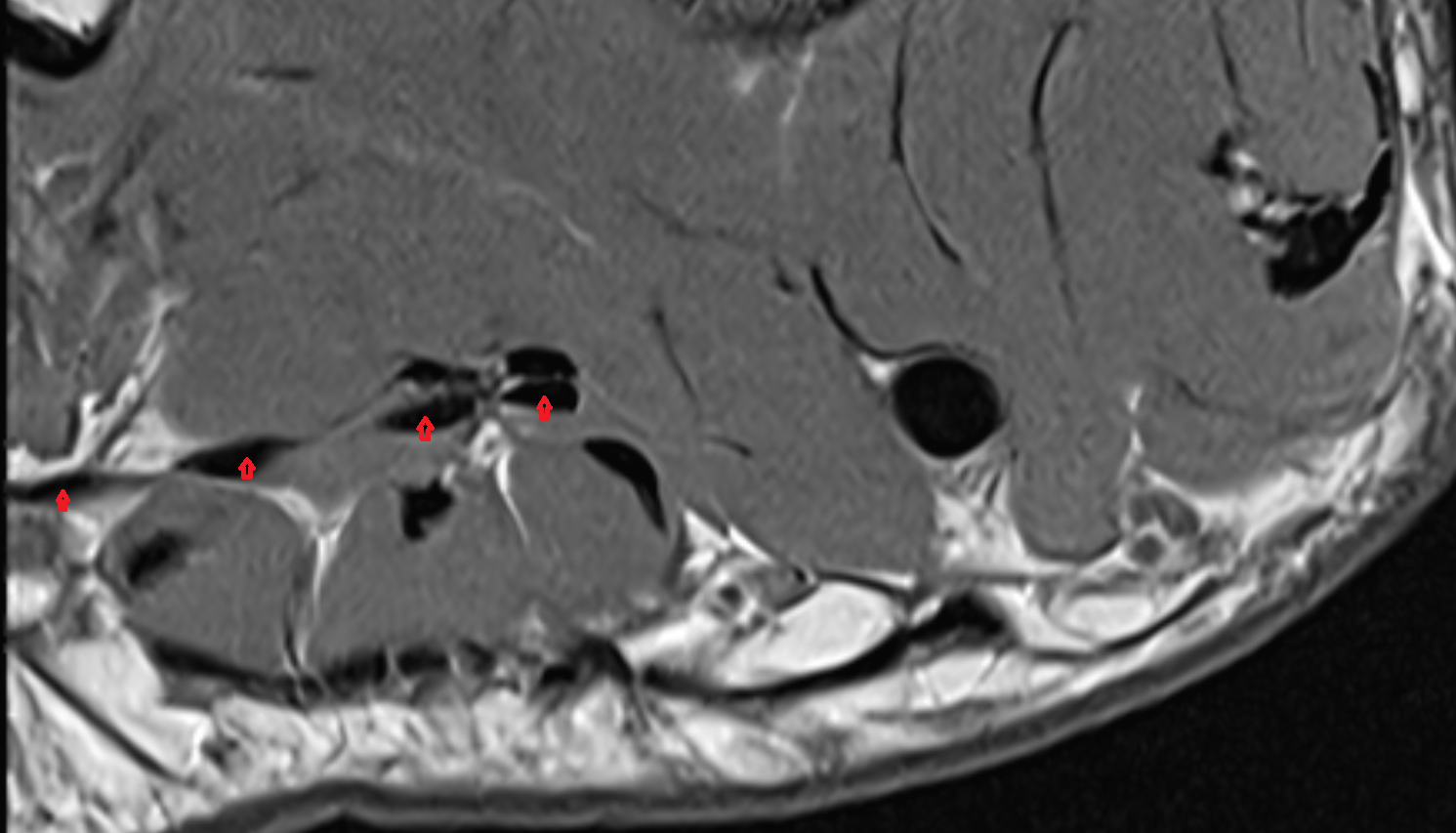 Flexor digitorum longus tendons sfov  of the Foot  axial cross sectional anatomy 3T MRI AI enhanced radiology image-img-00000-00000_00001