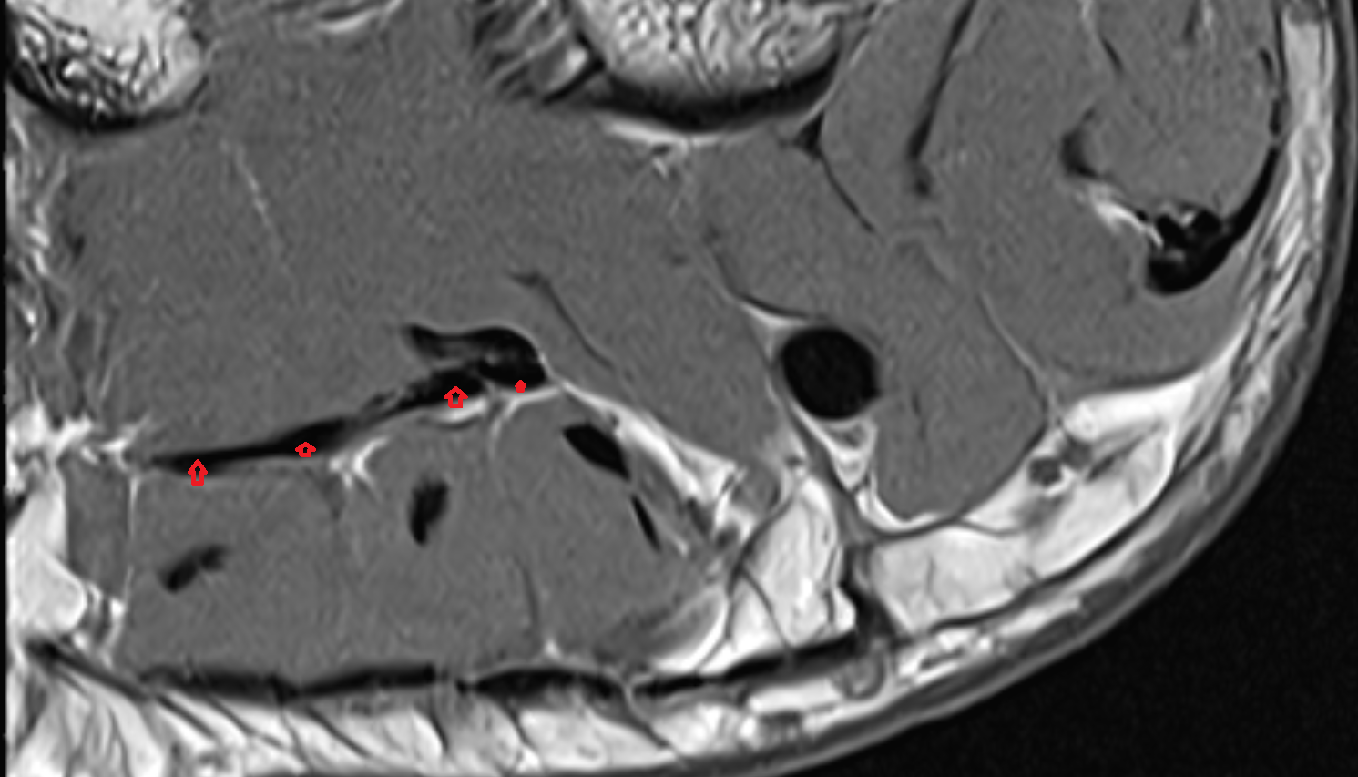 Flexor digitorum longus tendons sfov  of the Foot  axial cross sectional anatomy 3T MRI AI enhanced radiology image-img-00000-00000_00002