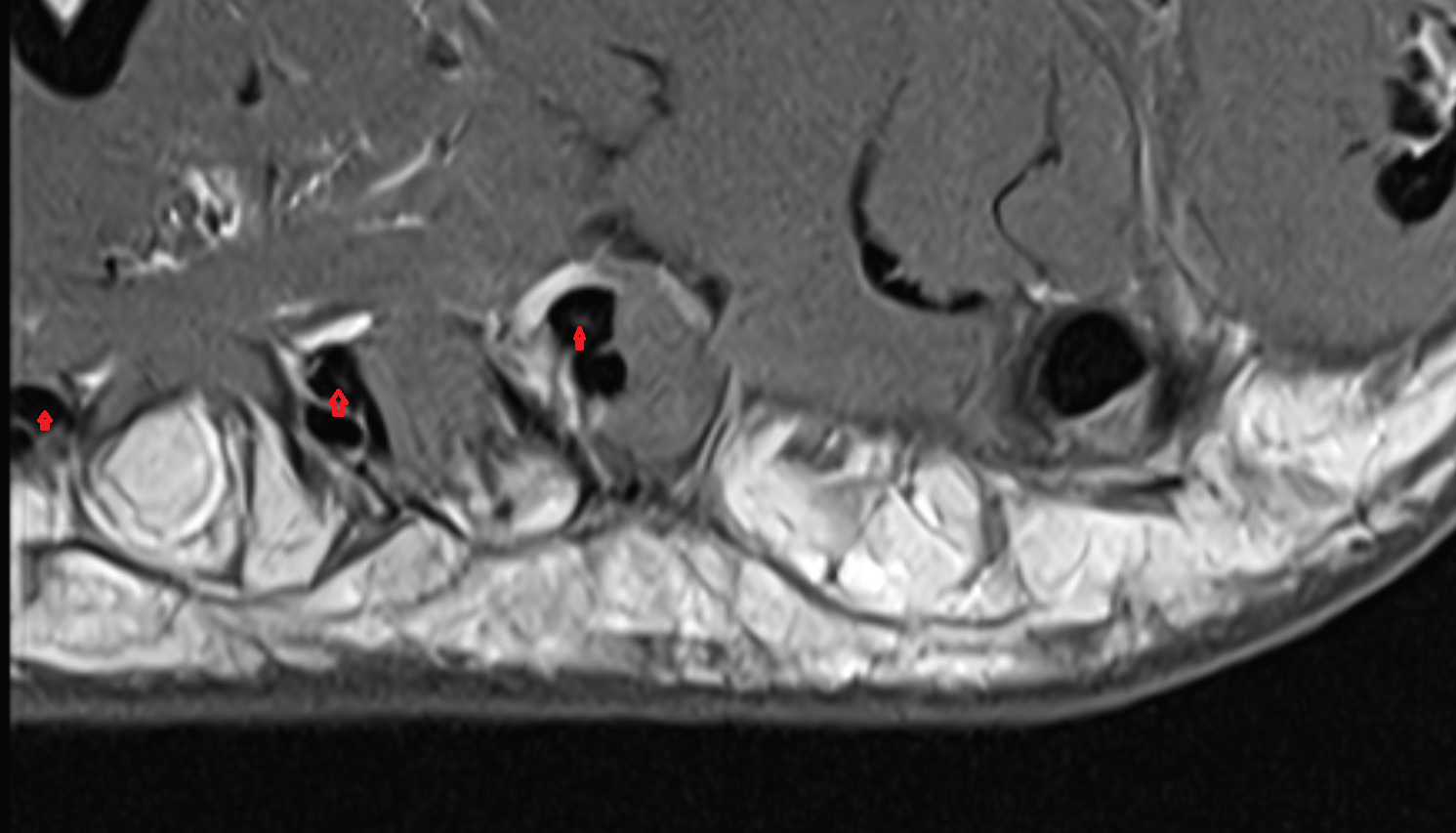 Flexor digitorum longus tendons sfov  of the Foot  axial cross sectional anatomy 3T MRI AI enhanced radiology image-img-00000-00000_00003