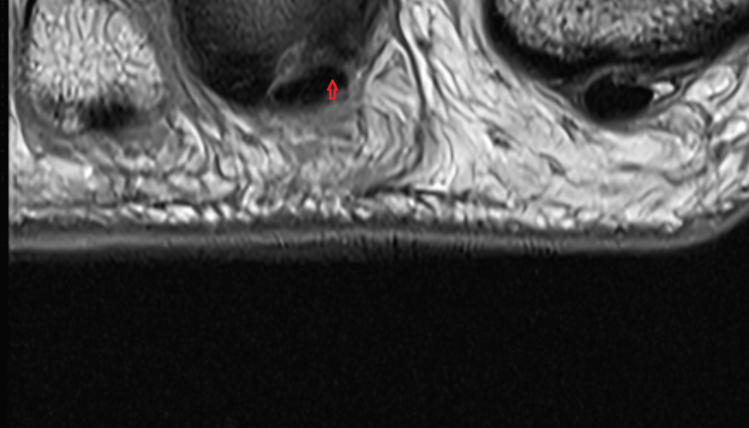 Flexor digitorum longus tendons sfov  of the Foot  axial cross sectional anatomy 3T MRI AI enhanced radiology image-img-00000-00000_00004