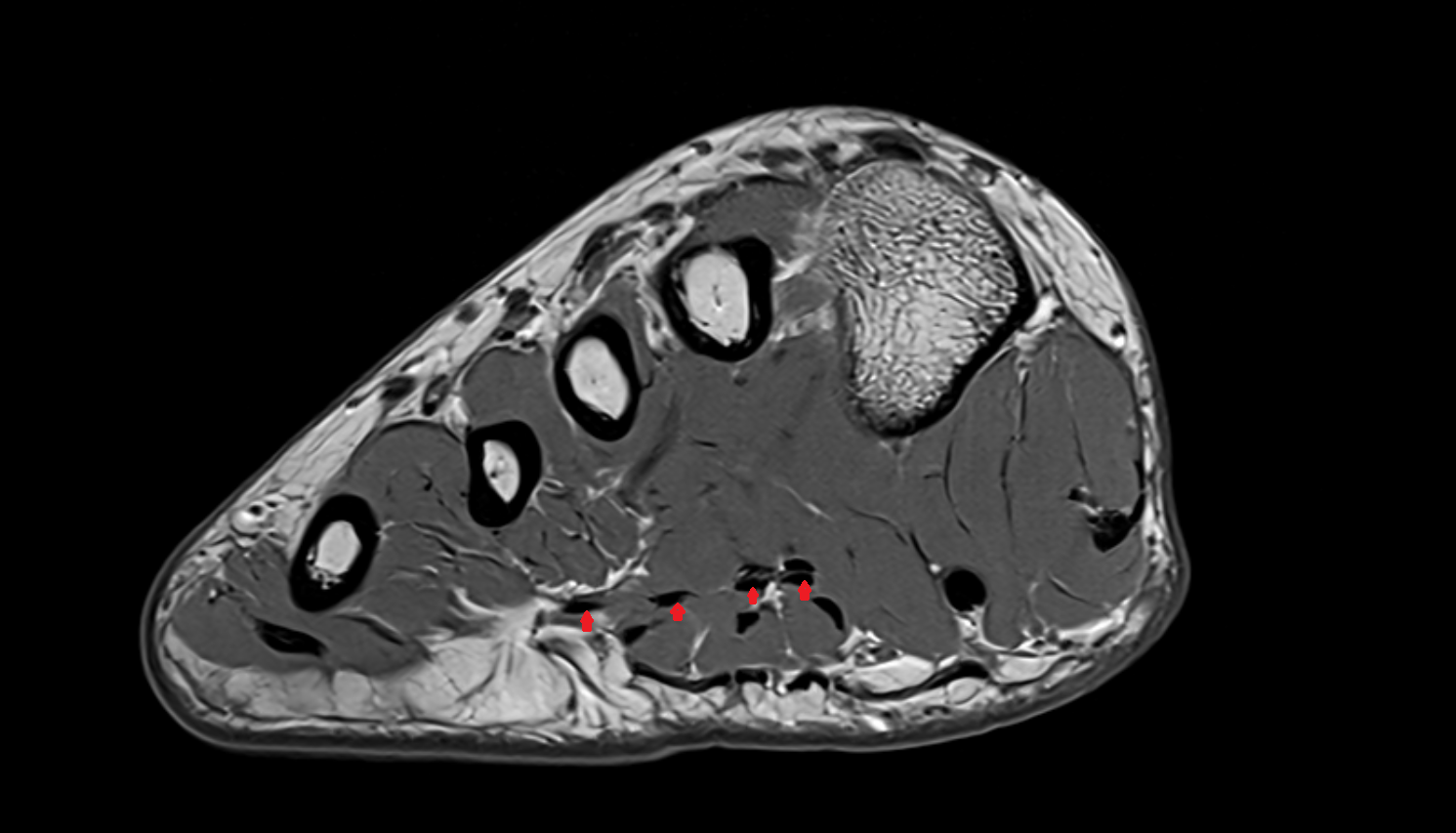 Flexor digitorum longus tendons sfov  of the Foot  axial cross sectional anatomy 3T MRI AI enhanced radiology image-img-00000-00000_00005