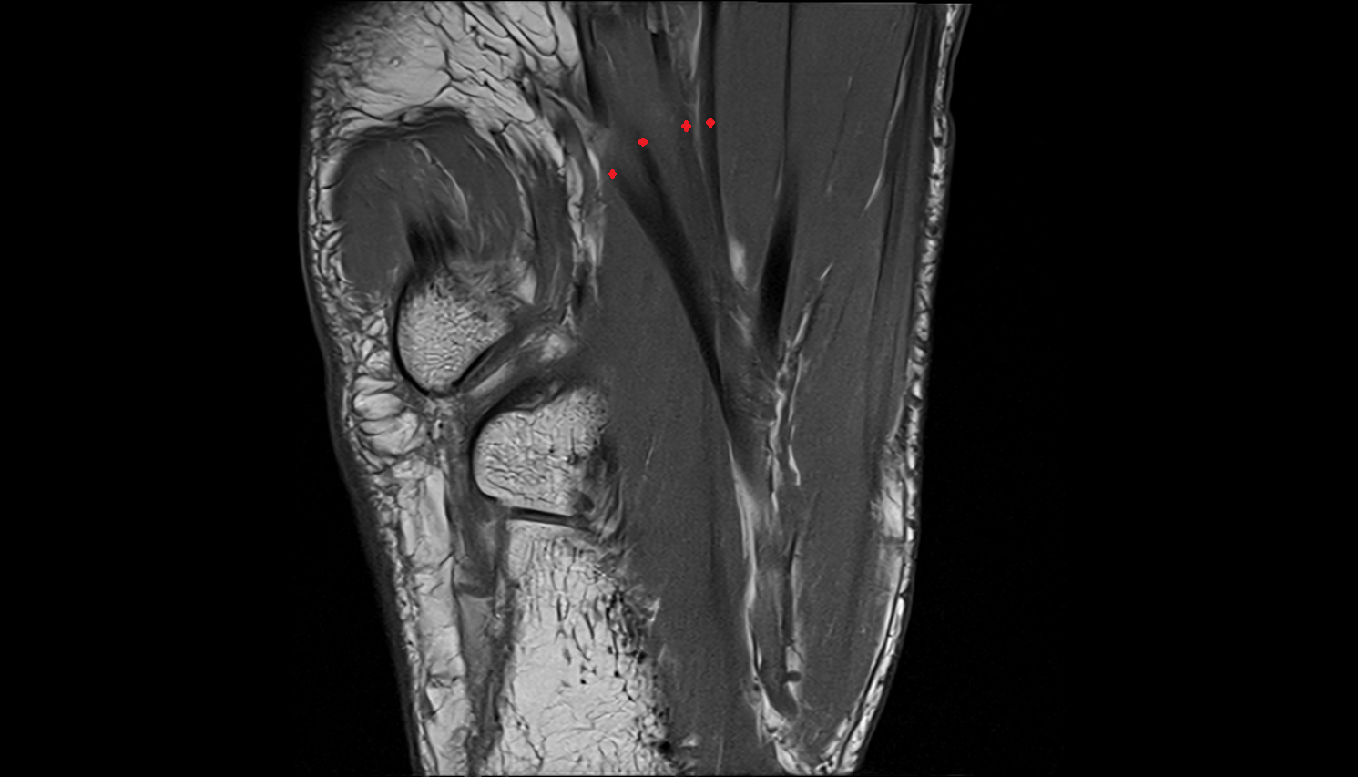 Flexor digitorum longus tendons sfov  of the Foot  axial cross sectional anatomy 3T MRI AI enhanced radiology image-img-00000-00000_00006
