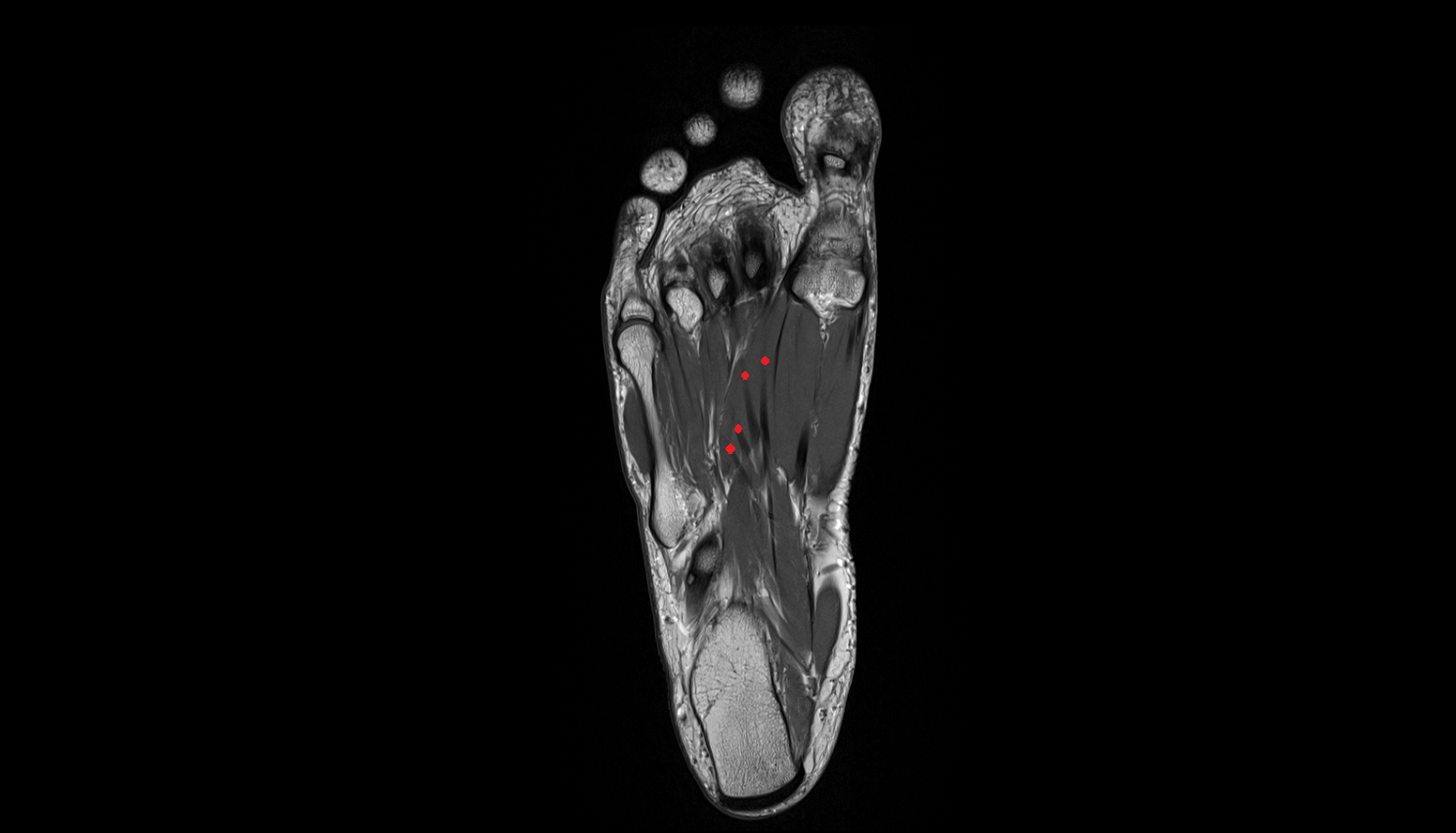 Flexor digitorum longus tendons sfov  of the Foot  axial cross sectional anatomy 3T MRI AI enhanced radiology image-img-00000-00000_00007