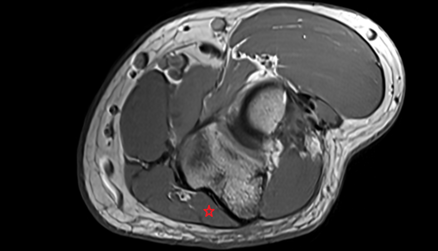 Flexor digitorum profundus axial cross sectional anatomy 3T MRI AI enhanced radiology image -img-00000-00000
