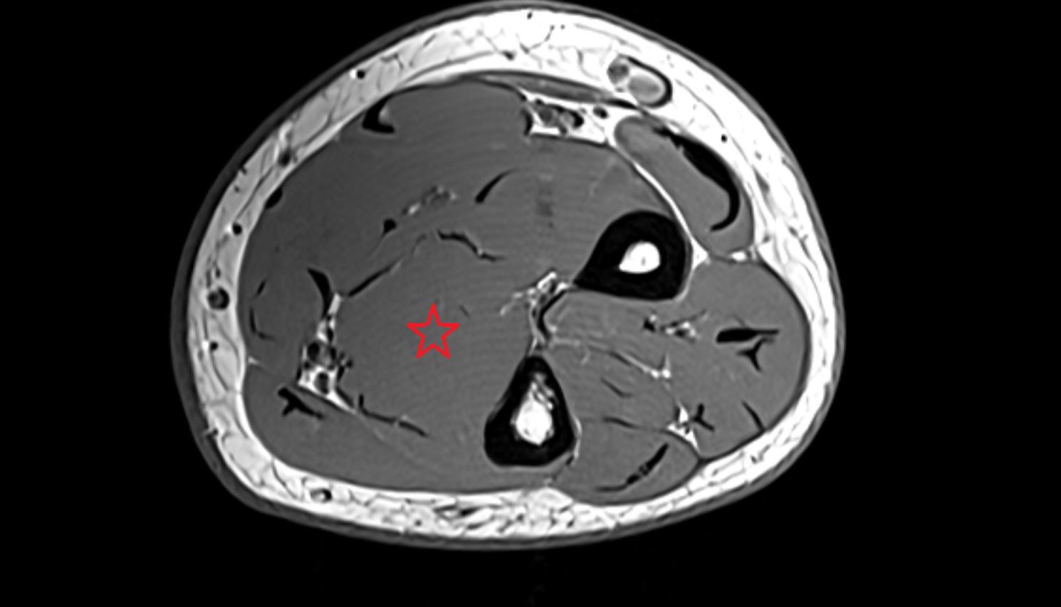 Flexor digitorum profundus axial cross sectional anatomy 3T MRI AI enhanced radiology image -img-00000-00000_00002