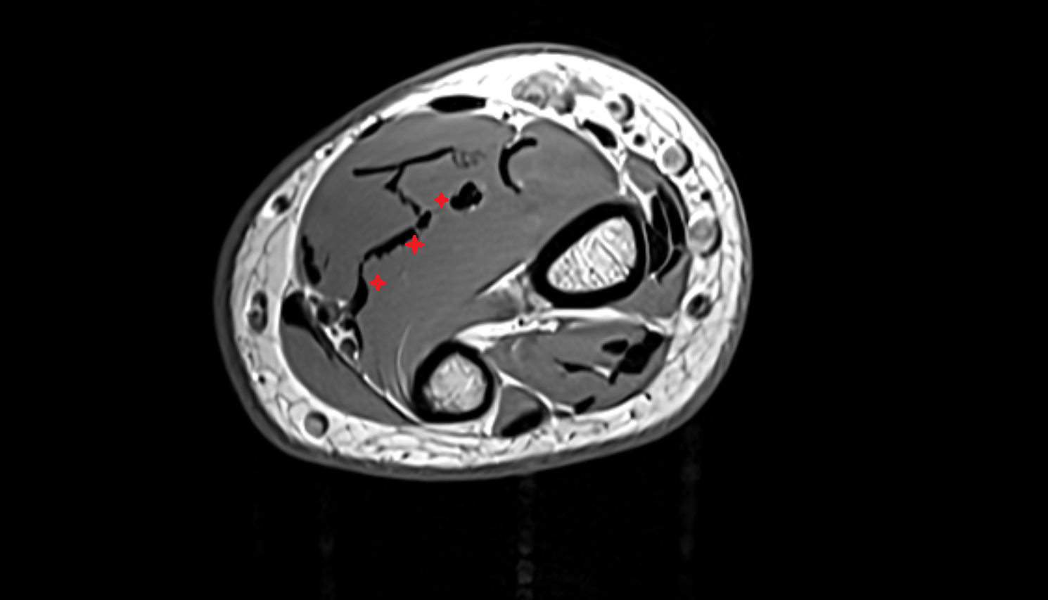 Flexor digitorum profundus axial cross sectional anatomy 3T MRI AI enhanced radiology image -img-00000-00000_00003