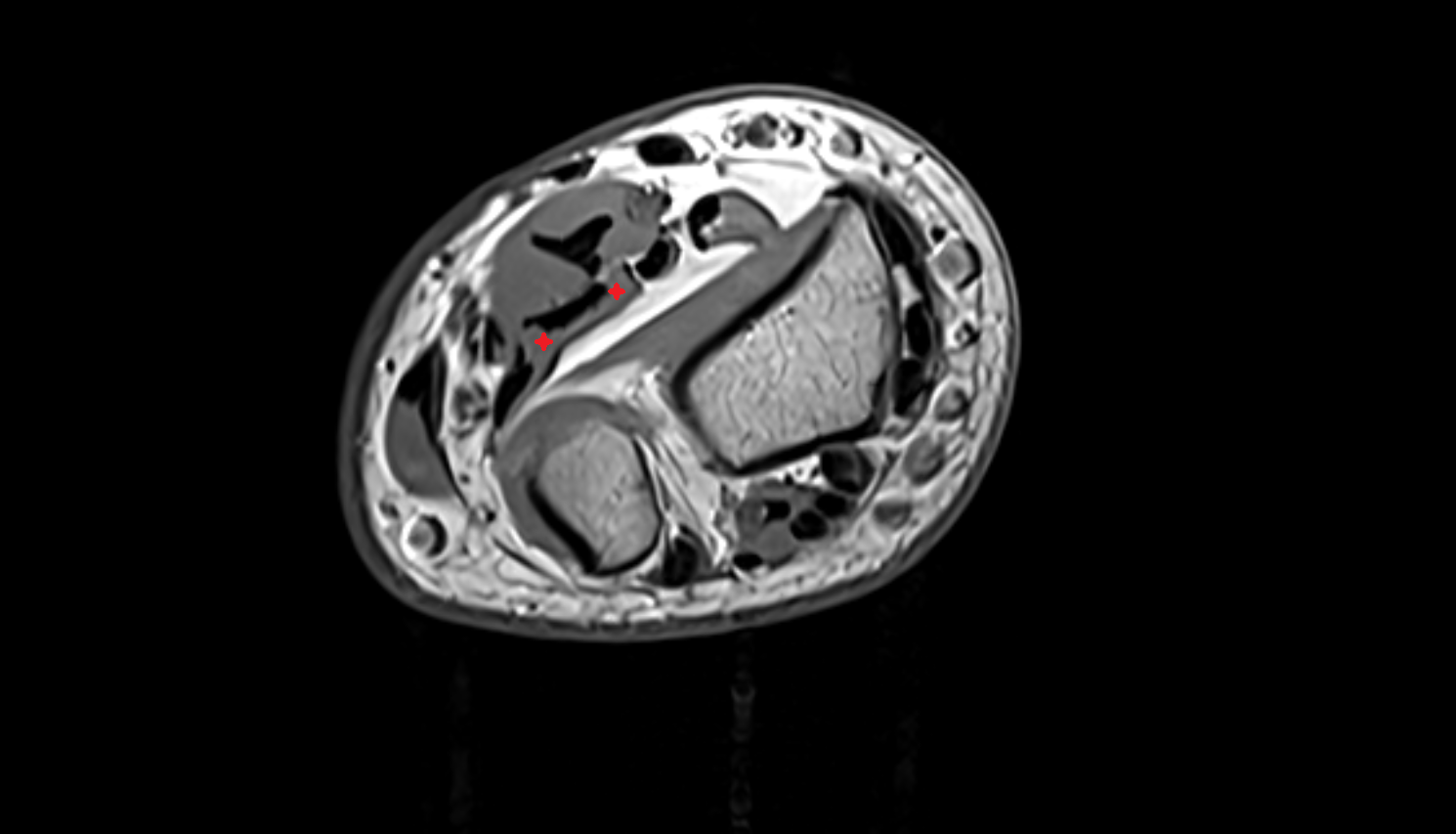 Flexor digitorum profundus axial cross sectional anatomy 3T MRI AI enhanced radiology image -img-00000-00000_00004