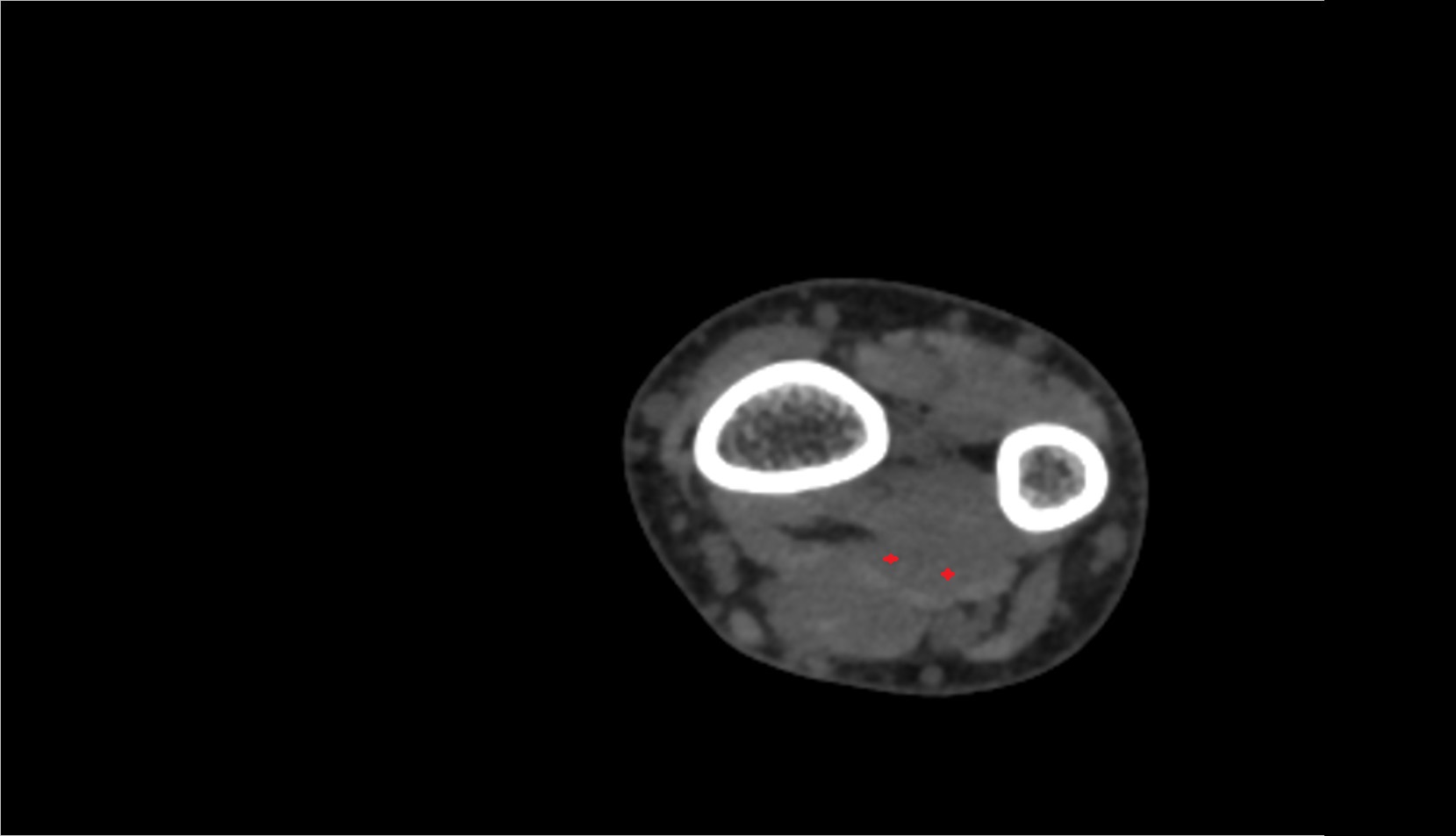 Flexor digitorum profundus ct axial