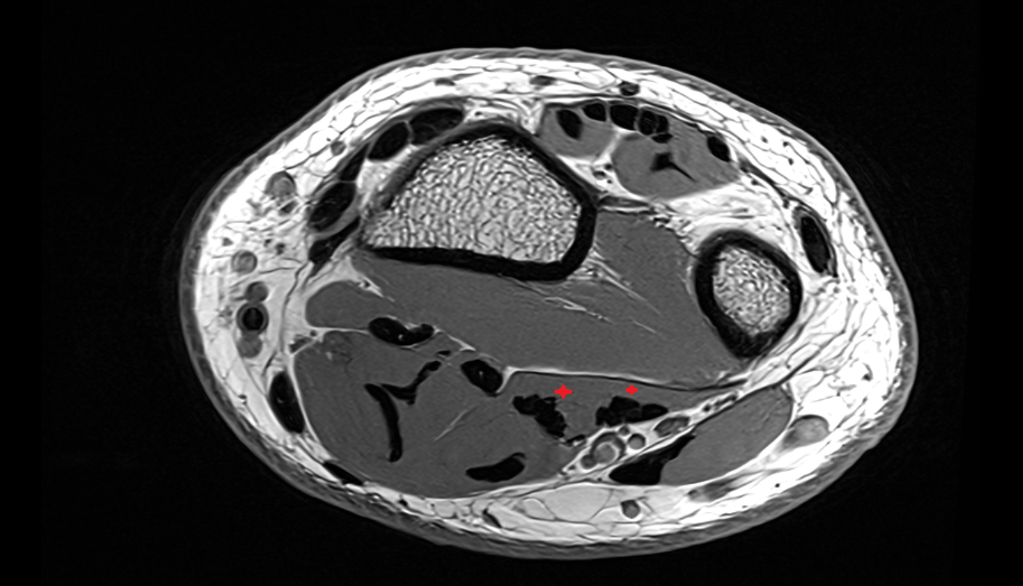 Flexor digitorum profundus  muscle axial cross sectional anatomy 3T MRI AI enhanced radiology image-img-00000-00000
