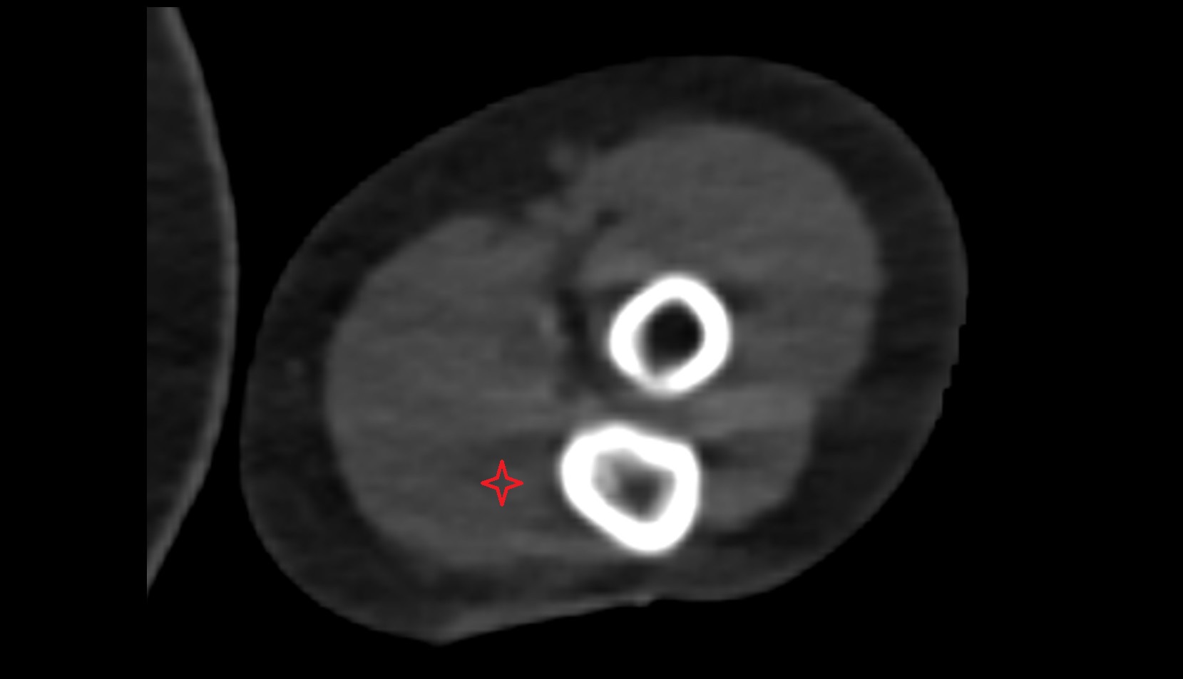 Flexor digitorum profundus muscle ct axial