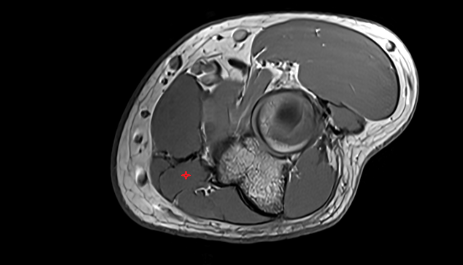 Flexor digitorum superficialis axial cross sectional anatomy 3T MRI AI enhanced radiology image -img-00000-00000