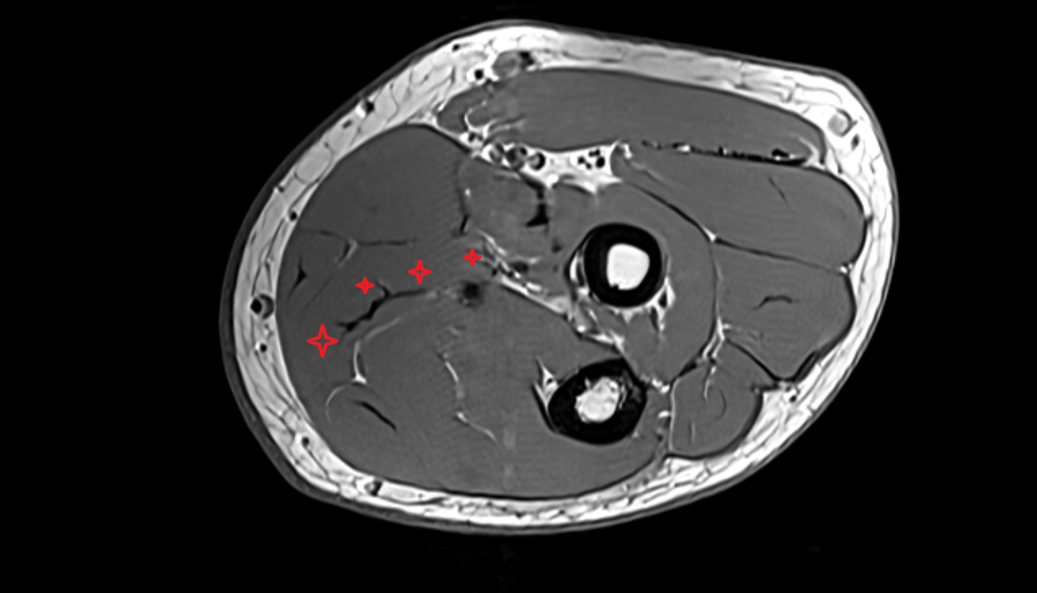 Flexor digitorum superficialis axial cross sectional anatomy 3T MRI AI enhanced radiology image -img-00000-00000_00001