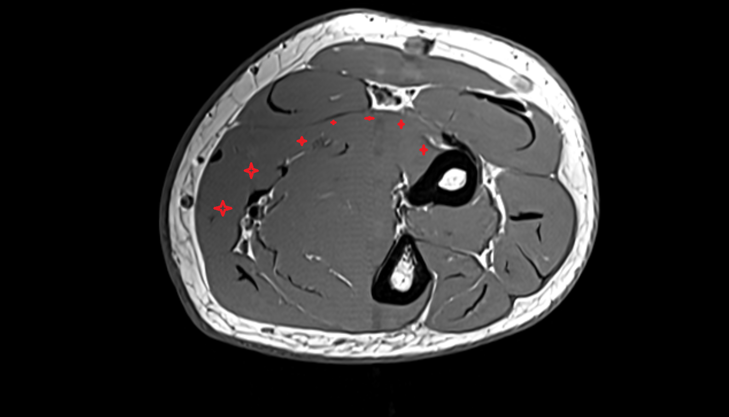 Flexor digitorum superficialis axial cross sectional anatomy 3T MRI AI enhanced radiology image -img-00000-00000_00002