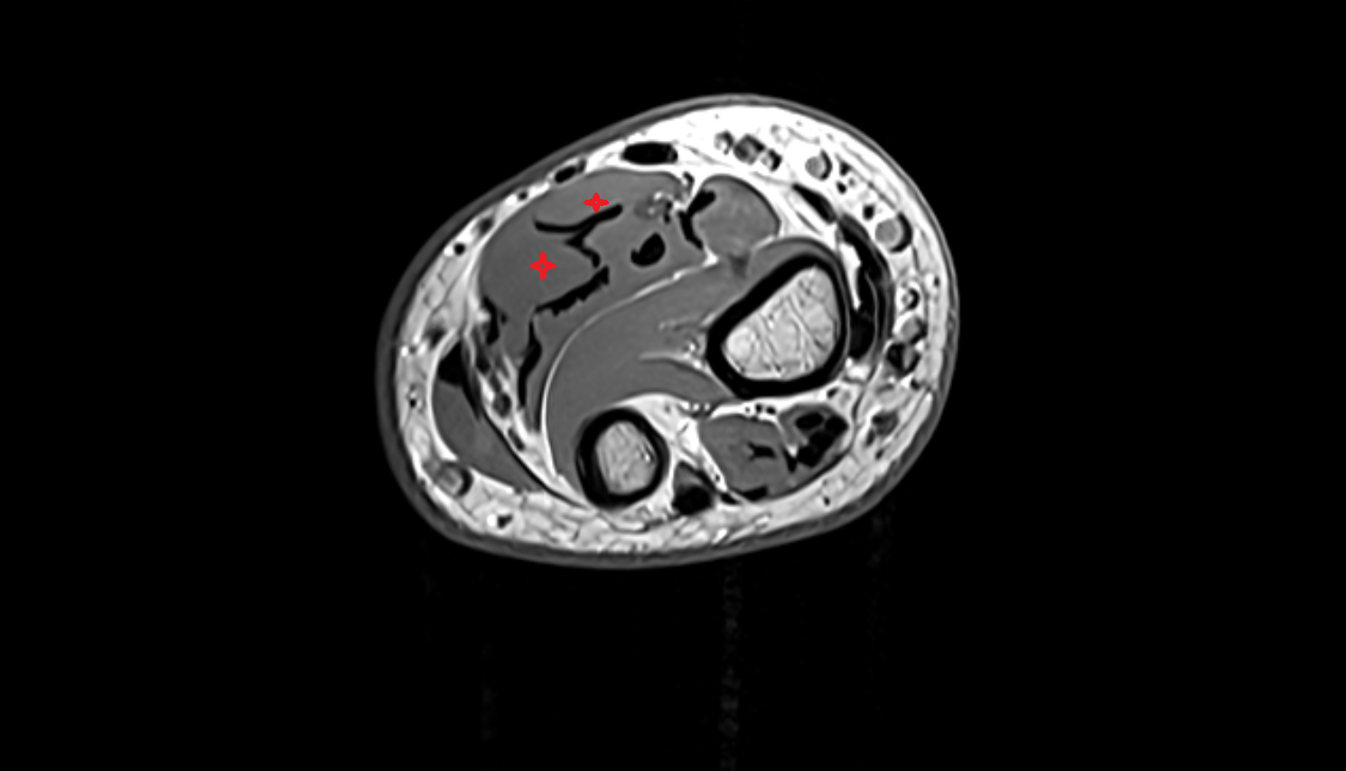 Flexor digitorum superficialis axial cross sectional anatomy 3T MRI AI enhanced radiology image -img-00000-00000_00003