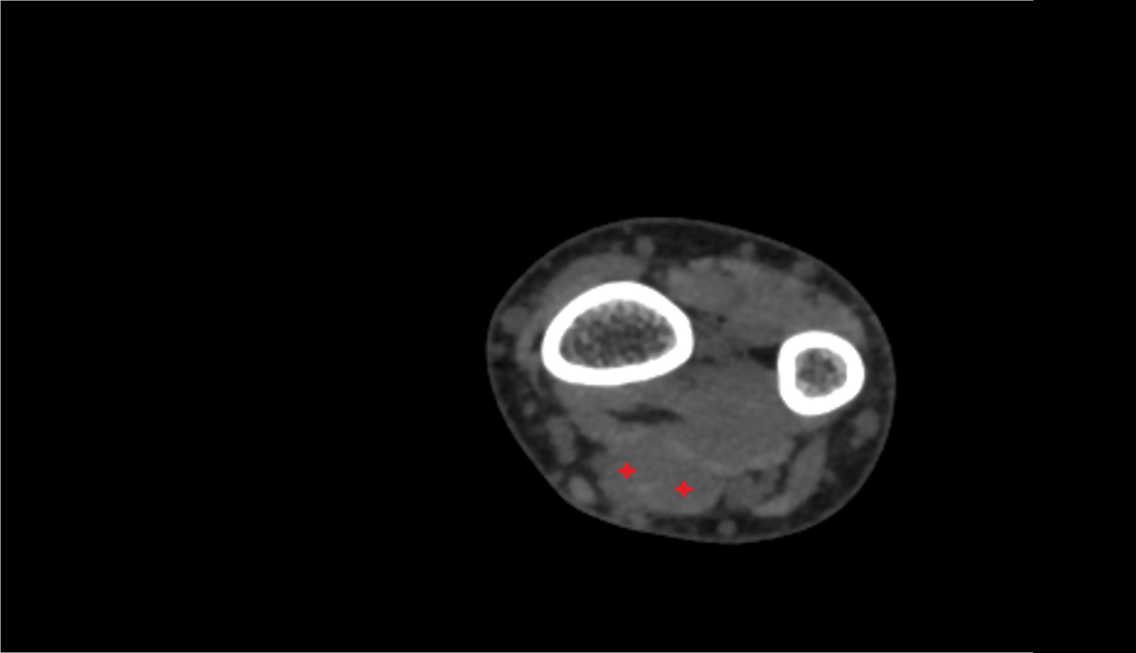 Flexor digitorum superficialis ct axial