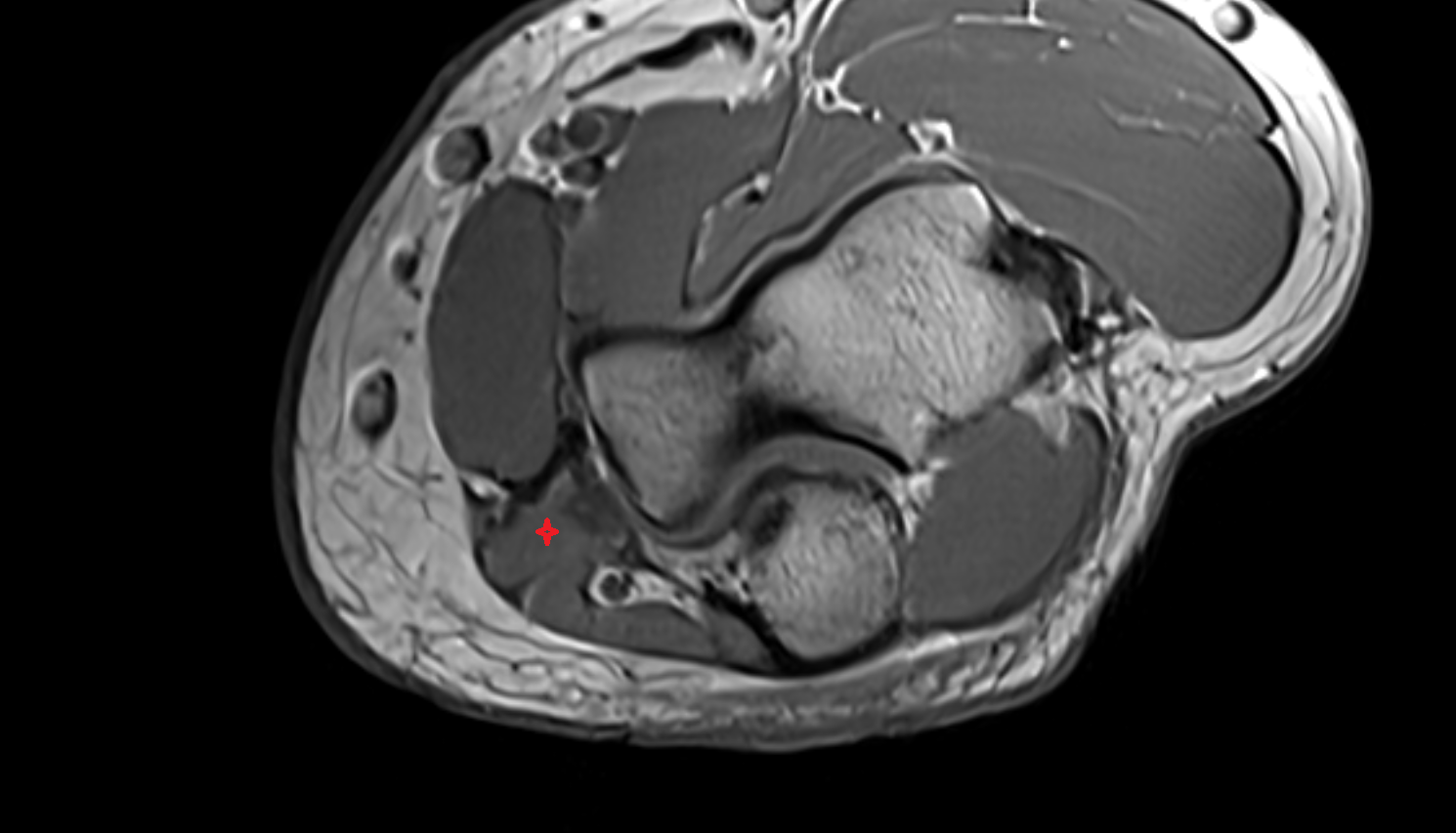 Flexor digitorum superficialis (humeroulnar head) axial cross sectional anatomy 3T MRI AI enhanced radiology image -img-00000-00000