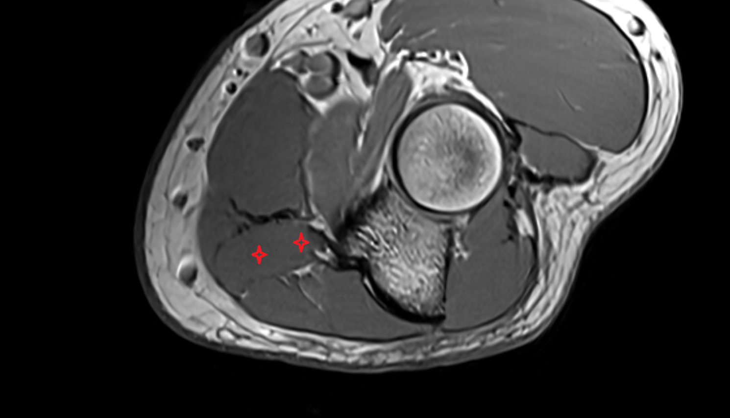 Flexor digitorum superficialis (humeroulnar head) axial cross sectional anatomy 3T MRI AI enhanced radiology image -img-00000-00000_00001