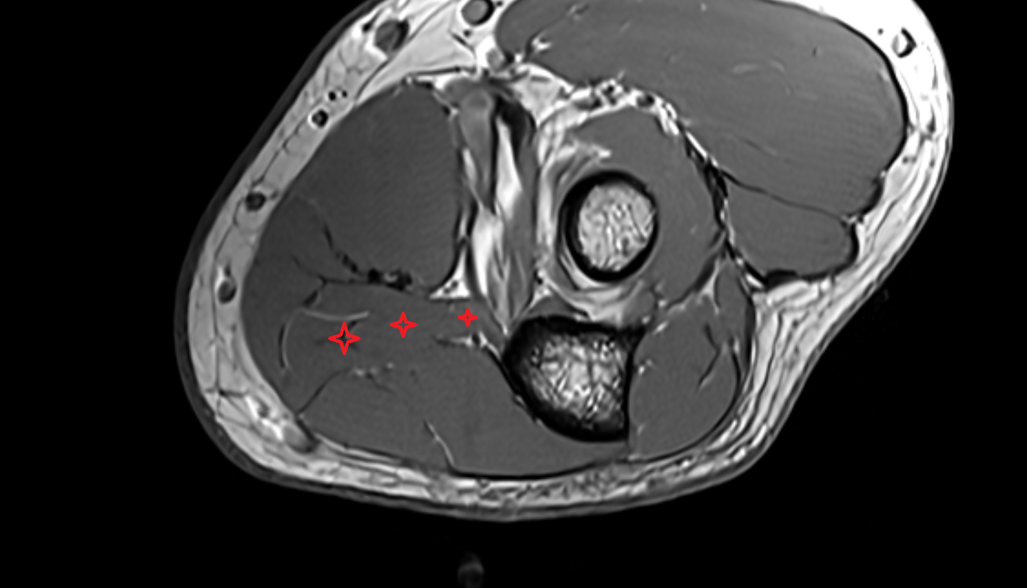 Flexor digitorum superficialis (humeroulnar head) axial cross sectional anatomy 3T MRI AI enhanced radiology image -img-00000-00000_00002