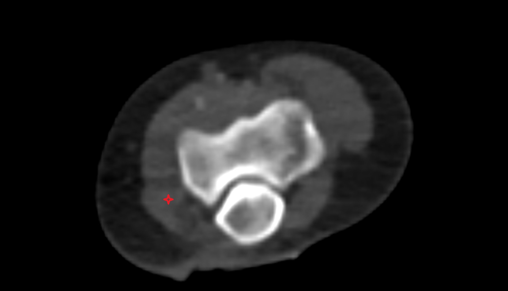 Flexor digitorum superficialis (humeroulnar head) ct axial