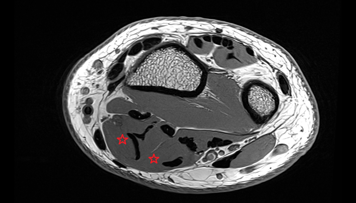 Flexor digitorum superficialis  muscle axial cross sectional anatomy 3T MRI AI enhanced radiology image-img-00000-00000
