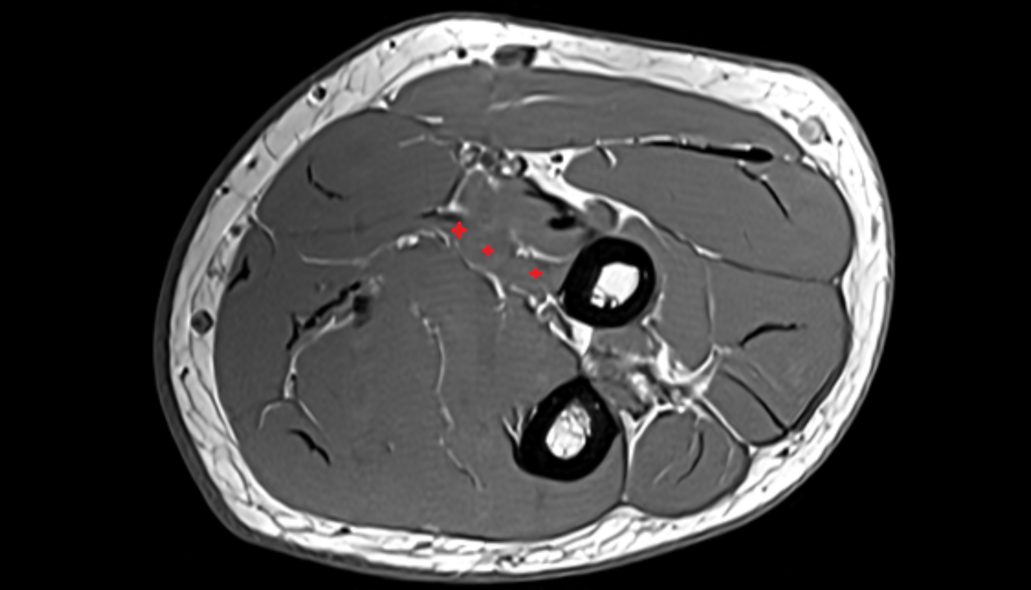 Flexor digitorum superficialis muscle (radial head) axial cross sectional anatomy 3T MRI AI enhanced radiology image -img-00000-00000