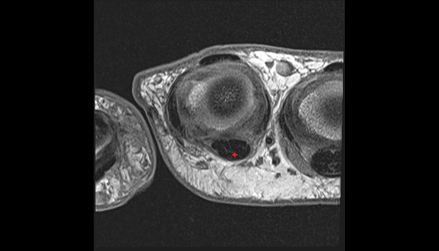 Flexor digitorum superficialis tendon MRI CORONAL image-img-00000-00000