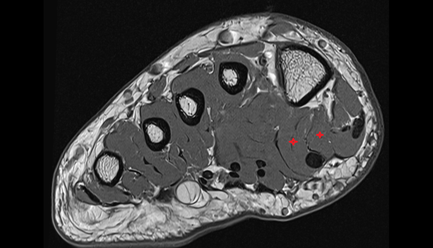 Flexor hallucis brevis muscle axial cross sectional anatomy 3T MRI AI enhanced radiology image-img-00000-00000