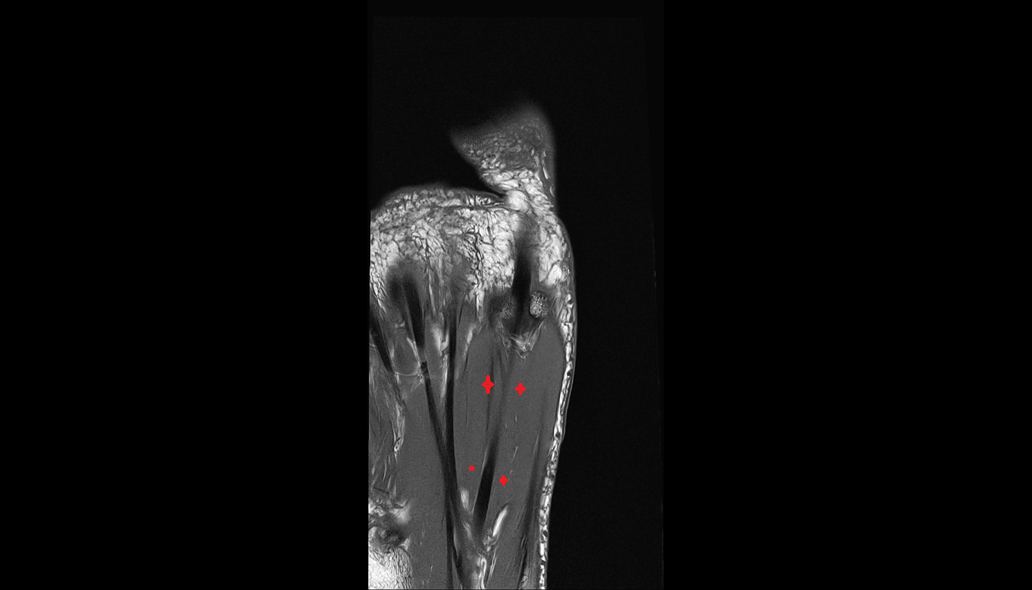 Flexor hallucis brevis muscle coronal cross sectional anatomy 3T MRI AI enhanced radiology image-img-00000-00000