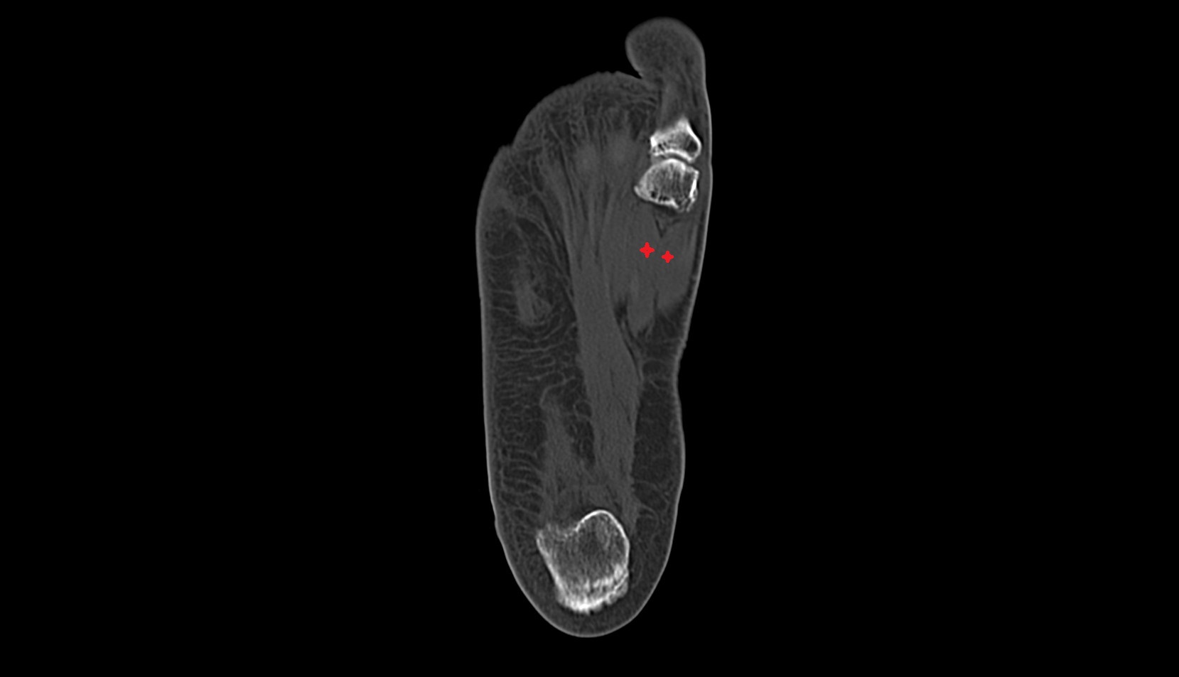 Flexor hallucis brevis muscle ct axial image