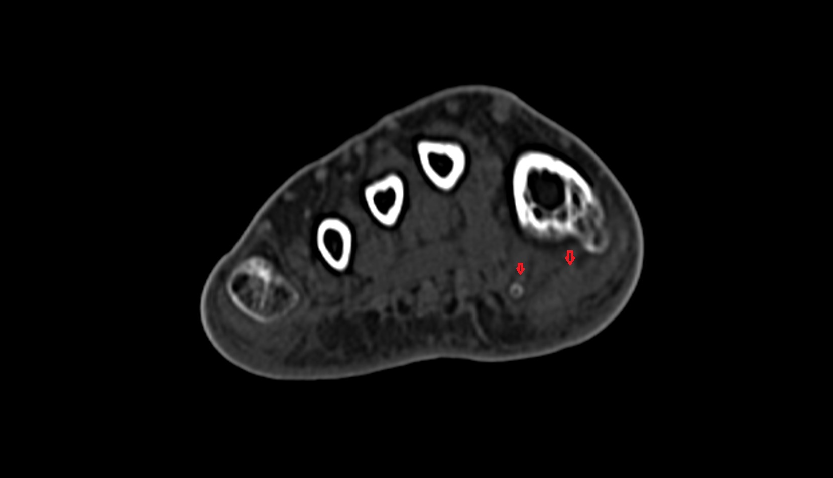 Flexor hallucis brevis tendons ct