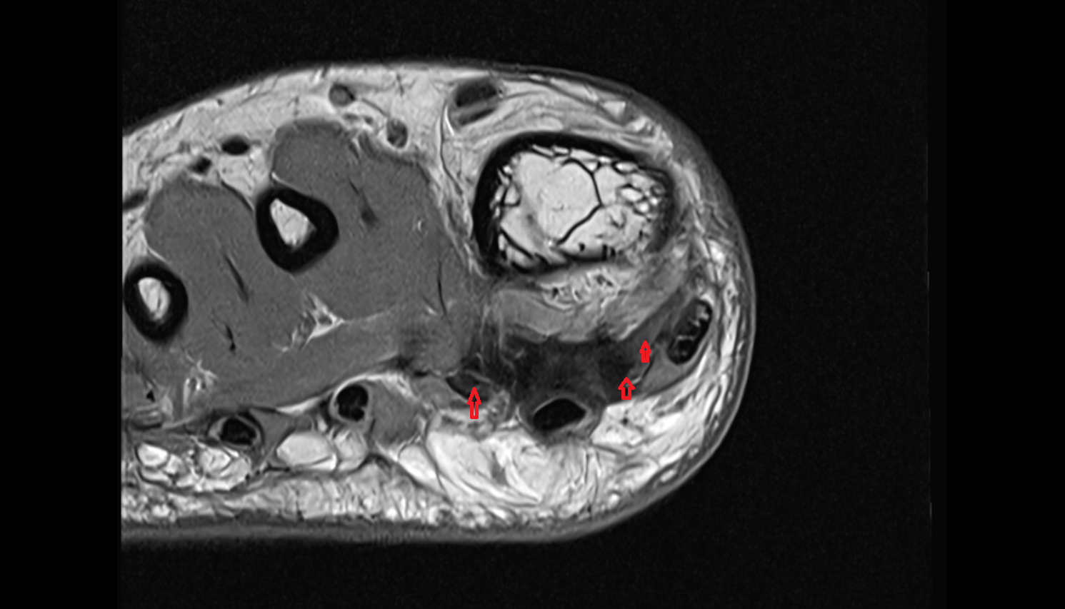 Flexor hallucis brevis tendons  of the Foot  axial cross sectional anatomy 3T MRI AI enhanced radiology image-img-00000-00000_00001