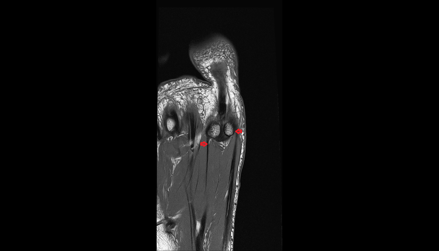 Flexor hallucis brevis tendons  of the Foot  coronalcross sectional anatomy 3T MRI AI enhanced radiology image-img-00000-00000