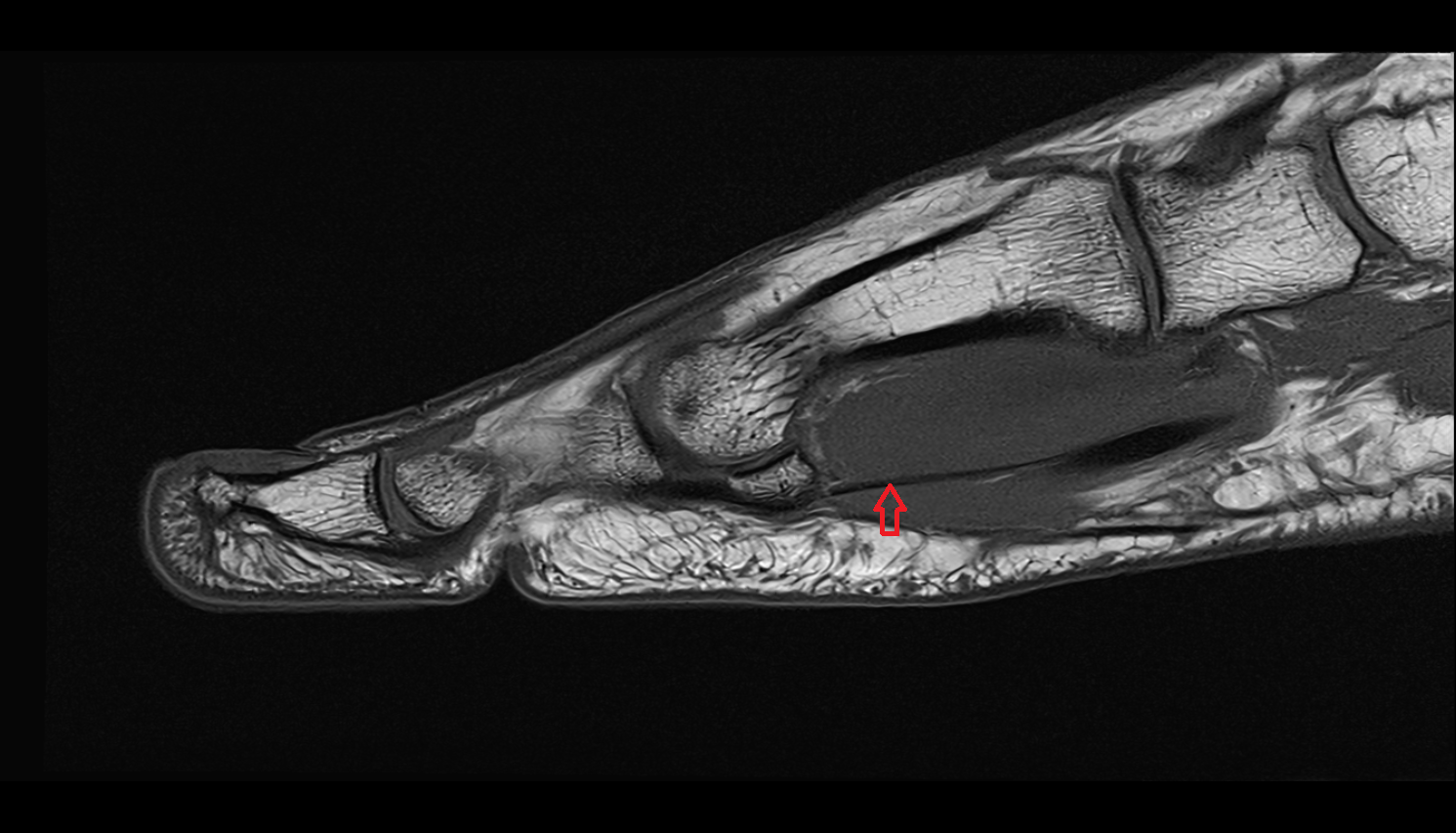 Flexor hallucis brevis tendons  of the Foot  sagcross sectional anatomy 3T MRI AI enhanced radiology image-img-00000-00000_00002