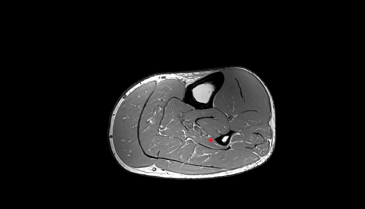Flexor hallucis longus muscle axial cross sectional anatomy 3T MRI AI enhanced radiology image-img-00000-00000