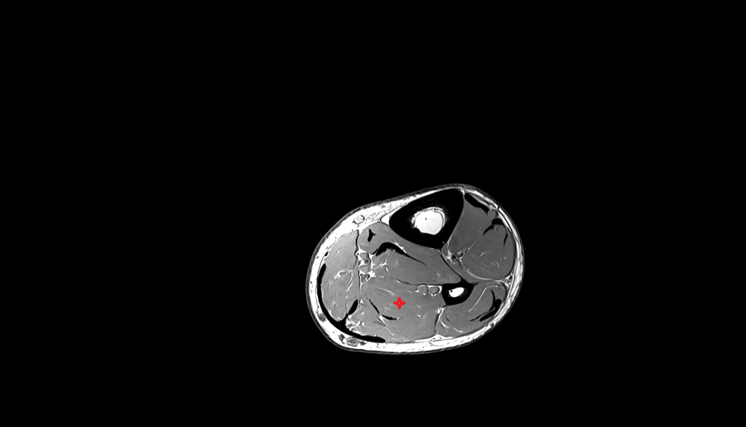 Flexor hallucis longus muscle axial cross sectional anatomy 3T MRI AI enhanced radiology image-img-00000-00000_00002