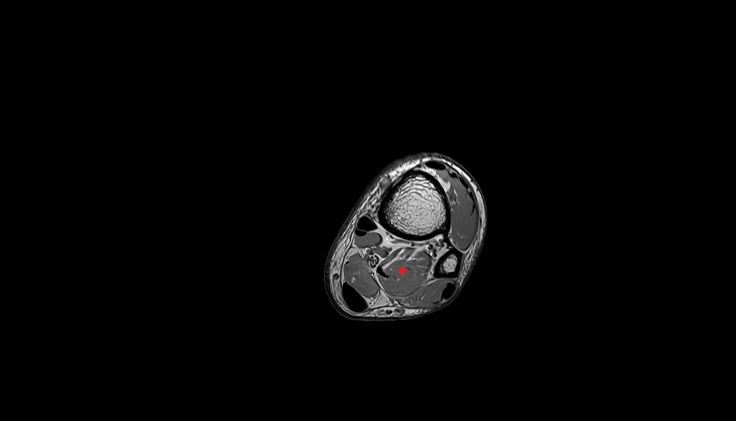 Flexor hallucis longus muscle axial cross sectional anatomy 3T MRI AI enhanced radiology image-img-00000-00000_00003
