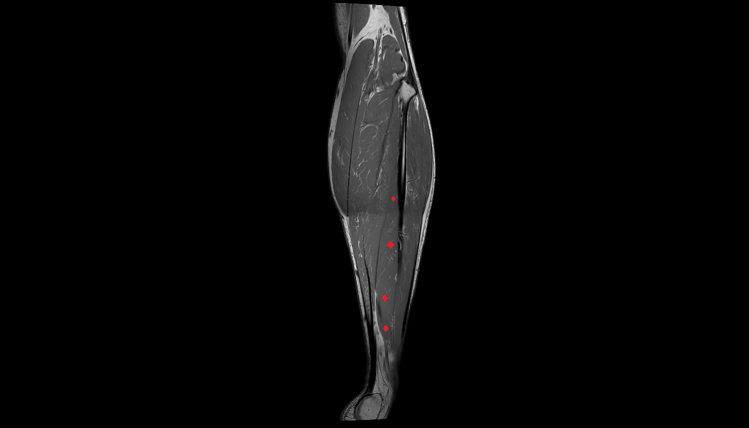 Flexor hallucis longus muscle coronal cross sectional anatomy 3T MRI AI enhanced radiology image-img-00000-00000