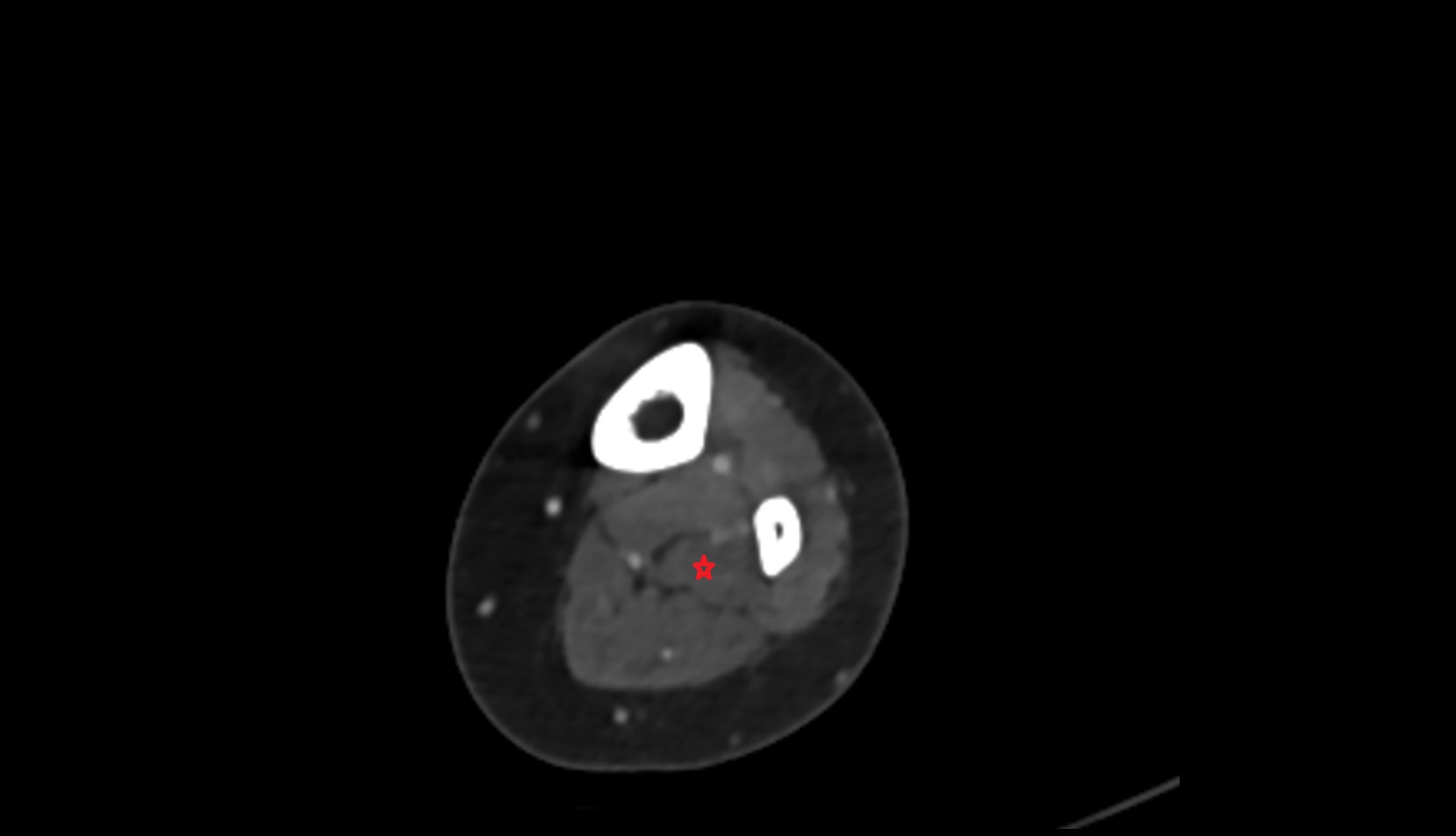 Flexor hallucis longus muscle ct axial
