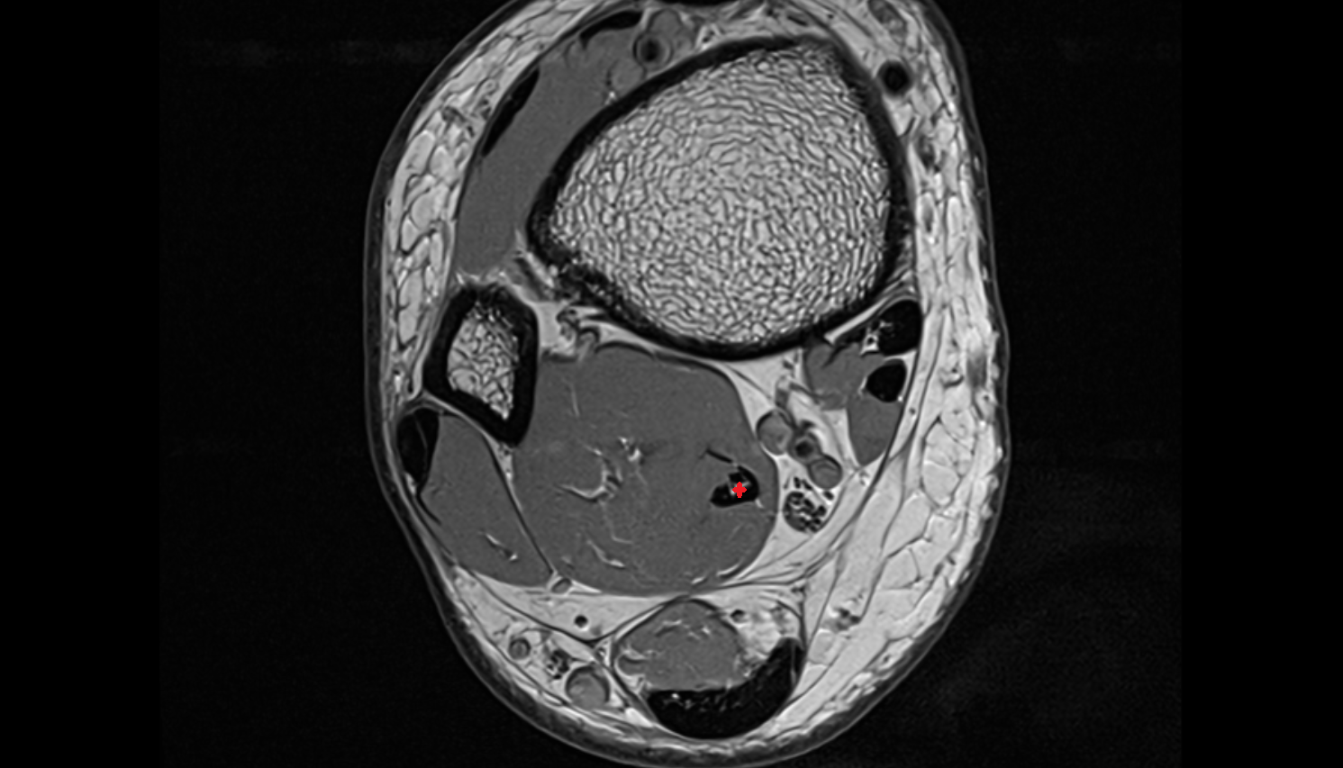Flexor hallucis longus tendon axial cross sectional anatomy 3T MRI AI enhanced radiology image-img-00000-00000_00001